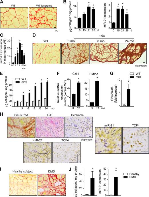 Figure 1. Dysregulated miR-21 expression in dystrophic muscle of DMD patients and mdx mice is associated with fibrotic outcome. (A) A representative example of increased collagen deposition (fibrosis), as detected by Sirius red staining of TA muscle of WT mice examined at 21 d after tissue injury induced by laceration. Bar, 25 µm. (B) Quantification of fibrosis (collagen levels) and miR-21 expression in muscles of WT mice before and at the indicated time points after laceration (*, P < 0.001 vs. 0 d; means ± SEM; n = 5 for each group). (C) miR-21 expression levels were analyzed in the diaphragm muscle of 0.5-, 1-, 3-, 8-, 12-, and 24-mo-old mdx mice by quantitative PCR. mdx mice values were normalized with respect to values of aged-matched WT mice (*, P < 0.001 vs. 0.5 mo; means ± SEM; n = 5 for each group). (D) A representative example of Sirius red staining of diaphragm muscle sections of 3-mo-old WT mice and of mdx mice at 3, 8, and 24 mo of age. Bar, 25 µm. (E) Collagen content was analyzed in the diaphragm muscle at the indicated ages in mdx and WT mice of the same ages (*, P < 0.001 vs. WT; means ± SEM; n = 4 for each group). (F) mRNA from diaphragms of mdx mice (and WT mice) of 3 and 12 mo of age was analyzed by quantitative PCR. The expression levels of fibrosis/ECM-related genes, collagen I (Coll I), and TIMP-1 are shown. Results are expressed as fold induction overexpression levels in WT mice (*, P < 0.01; means ± SEM; n = 4 for each group). (G) Quantification of fibroblasts after detection by immunohistochemistry using antibodies against FSP-1 and TCF-4 in the diaphragm of WT and mdx mice. Data obtained from both markers were averaged and expressed as a fold increase in mdx versus WT muscles (*, P < 0.001; means ± SEM; n = 4 for each group). (H) Serial sections of mdx diaphragms were subjected to ISH with a specific probe for miR-21 expression or a scrambled control probe (ISH in WT samples is shown in Fig. S1 D), immunostaining using antibodies specific for TCF-4, Sirius red staining for collagen detection, and H/E. A blood vessel is outlined (dashed line) in all pictures as a reference. Squares indicate the insets shown at the right at higher magnifications. Bars, 25 µm. (I) A representative example of Sirius red staining in sections of muscle biopsies from DMD patients and healthy control subjects. Bar, 25 µm. (J) Collagen accumulation and miR-21 expression were analyzed in muscle biopsies of DMD patients and healthy controls (*, P < 0.01; means ± SEM; n = 7 patients 6–12 yr of age; n = 6 healthy 9–15 yr of age).