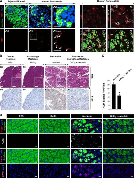 Figure 1. Depletion of macrophages blocks pancreatic ADM. (A) Samples of human pancreatitis or adjacent normal tissue were stained by immunofluorescence for macrophages (EMR1), amylase, CK-19 (gray in A6), and DAPI as indicated. Bars, 20 µm. (B) FVB mice were treated with control vehicle, GdCl3, caerulein, or a combination, as indicated (detailed method in Materials and methods section). Pancreata were harvested and IHC stained with H&E or the macrophage marker F4/80. Boxes in A and B indicate enlarged regions. (C) Quantitation of ADM events per field of n = 5 samples from B. The asterisk indicates statistical significance as determined by the Student’s t test. Error bars show means ± SD. (D, top row) Immunofluorescence staining of F4/80, amylase, and DAPI in samples from FVB mice treated with control vehicle, GdCl3, caerulein, or a combination, as indicated (detailed method in Materials and methods section). (second row) F4/80 channel alone in white. (third row) Immunofluorescence staining of CK-19, amylase, and DAPI. (fourth row) CK-19 channel and DAPI. Bars, 25 µm. See also Fig. S1.