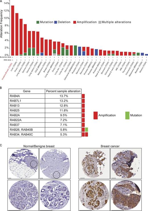 Figure 10. RAB4A is amplified in invasive breast cancer. (A) RAB4A is amplified in various tumors. The cBio Cancer Genomics Portal (http://www.cbioportal.org/public-portal/) was queried for RAB4A across various tumor datasets. The alteration frequency, type of alterations of RAB4, availability of mutation analysis, and Copy Number Alteration (CNA) in the various tumor cohorts are shown. (B) RAB4A is, among the RAB family members, the most frequently amplified gene in invasive breast carcinoma. The percentage of each RAB gene amplification in invasive breast carcinoma reported in the Cancer Genome Atlas (TCGA) is shown. Only the genes with a frequency of amplification >5% are shown. (C) RAB4A is overexpressed in breast cancer. Shown are examples of the data of Table S2. Circled areas are enlarged below. Bars, 100 µm.