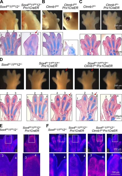 Figure 4. Genetic interaction between SoxC and Ctnnb1. (A–D) External and histological aspect of hind paws from E14.5 SoxC/Ctnnb1/Prx1CreER control, partial, and compound mutant embryos. (A) The Sox4fl/fl11fl/fl12−/−Prx1CreER paw displays anterior–posterior (red arrow) fusions of cartilage primordia. (B) The Ctnnb1fl/flPrx1CreER paw is tiny and malformed and has a large hematoma (H). (C) The Ctnnb1fl/+Prx1CreER paw is normal. (D) Most Sox4fl/+11fl/fl12+/−Prx1CreER paws are normal (left), but some develop soft-tissue syndactyly of digits 3 and 4 (red arrow, right). Most Sox4fl/+11fl/fl12+/−Ctnnb1fl/+Prx1CreER paws show soft-tissue fusions without (left) or with (right) cartilage fusions. Also see Table S1. (E and F) SOX9 immunostaining (red) in sections adjacent to those in A–D. Top images are composites of more than one original image. Bottom images are magnified pictures of boxed regions from a single image. They show SOX9 continued expression between digits 3 and 4 in SoxCPrx1CreER (E) and SoxC/Ctnnb1Prx1CreER limbs (F). Data were reproduced in at least three experiments. Each panel shows representative results.