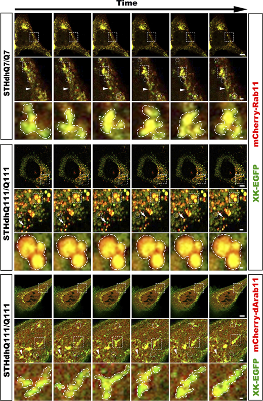 Dynamics of Rab11 endosomes in HD striatal cells declines and is enhanced upon expression of dominantly active Rab11. Time-lapse cell imaging of SThdhQ7/Q7 cells expressing XK-EGFP and mCherry-Rab11, SThdhQ111/Q111 expressing XK-EGFP and mCherry-Rab11, and SThdhQ111/Q111 expressing XK-EGFP and mCherry-dArab11. Prior to imaging and during the whole period of imaging, cells were treated with β-cycloheximide to ascertain the detection of XK-EGFP in the endocytic pathway. A series of six consecutive frames were chosen from Videos 1, 3, and 5, respectively, to highlight cotrafficking of XK-EGFP with mCherry-Rab11 or with mCherry-dArab11 in motile vesicles and the dynamics of large tubulovesicular structures labeled with XK-EGFP and mCherry-Rab11 or with XK-EGFP and mCherry-dArab11. Boxed regions were enlarged and shown below the corresponding frame. Arrows in insets trace motile structures containing both XK-EGFP and mCherry-Rab11/dArab11, whereas arrowheads point to structures changing in their size. Dashed circles indicate motile structures containing both XK-EGFP and mCherry-Rab11/dArab11 disappearing in the following images, and dashed polygons identify those appearing in the following images. Enlarged dashed contours indicate dynamic changes in the morphology of large vesiculotubular structures, likely reflecting events of vesicle fusion and budding. Scale bars in the last frame of each of SThdhQ7/Q7, SThdhQ111/Q111, and SThdhQ111/Q111 + dArab11: 10 μm (upper), 2 μm (middle), and 0.5 μm (lower). Source data are available for this figure: SourceData F3.