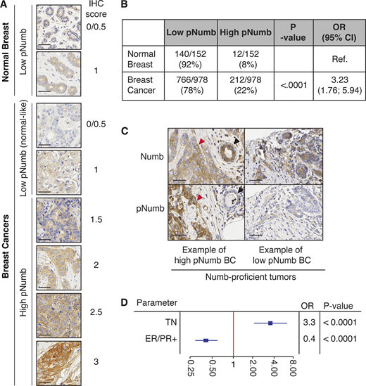 Clinical relevance of pNumb in human BCs. (A) IHC of pNumb in normal and tumor breast tissues, with IHC scores. Bars, 50 µm. (B) Analysis of pNumb (low pNumb, IHC ≤ 1; high pNumb, IHC > 1). OR, odd ratio, CI, confidence interval. (C) Representative IHC images of Numb and pNumb status in a high pNumb and a low pNumb BC. Both tumors are Numb-proficient (Numb IHC ≥ 2, top panels). In the high pNumb BC, the tumor (red arrow) is pNumb high, while a normal gland (black arrow) is pNumb low. Bar. 50 µm. (D) Forest Plot of association between high pNumb and some clinical and pathological parameters. TN, triple-negative BCs, ER/PR+, estrogen and progesterone receptor positive BCs. OR, odds ratio. The complete set of data is in Table S4. In B and D, statistical analysis was with the nonparametric Fisher’s exact test. Refer to the image caption for details.