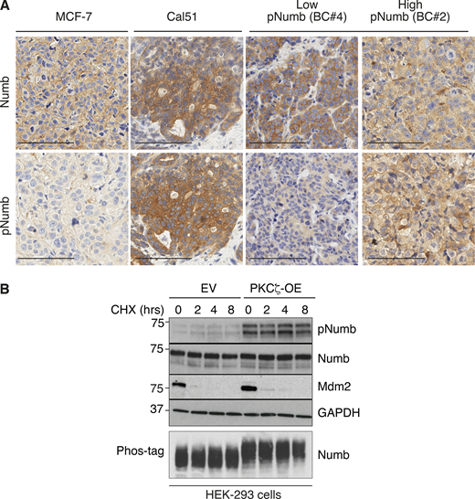 Additional data to Fig. 3. (A) The two breast cancer cell lines, MCF-7 and Cal51 used in Fig. 3, H and I, were grown as xenografts and stained for Numb and pNumb in IHC, in comparison to two PDXs from Numb-competent tumors displaying low pNumb (BC #4) and high pNumb (BC #2; the BCs in object are described in details in Fig. 8) to provide additional proof that they are representative of the situation occurring in real breast cancers. Bar, 100 μm. (B) The phosphorylation of Numb executed by PKCζ does not appreciably affect the half-life of Numb. HEK-293 cells were transduced with Venus (EV) or PKCζ-Venus (PKCζ -OE), as shown on the top, and then treated with cycloheximide (CHX, 50 μg/ml) for the indicated lengths of time. Lysates were immunoblotted as shown (top four panels). Mdm2 was used as control for a short half-lived protein. GAPDH is a loading control. In the lower panel (Phos-tag), the lysates were fractionated on an 8% Phos-tag gel (see Materials and methods) and then IB with anti-Numb. The nearly complete shift on Numb in the PKCζ-OE cells indicates that the phosphorylation of Numb executed by PKCζ is nearly stoichiometric. Source data are available for this figure: SourceData FS3.