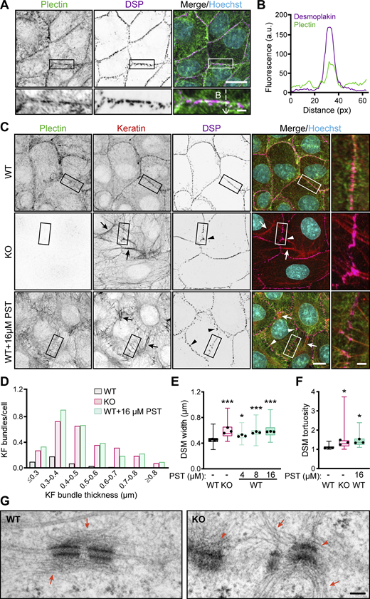 CRISPR/Cas9- or PST-mediated plectin inhibition disrupts cytoarchitecture of KF-DSM networks in epithelial monolayers. (A) Representative confocal images of MDCK cell monolayers immunolabeled for plectin (green) and DSP I/II (magenta). Nuclei, Hoechst (cyan). Dashed line, line scan in B. Boxed areas, ×2 images. Scale bars, 10 and 3 μm (boxed areas). (B) Line-scan analysis of DSP and plectin fluorescence intensity (indicated in A). (C) Representative confocal images of WT, KO, and PST-treated (16 μM, 4 h) WT monolayers immunolabeled for plectin (green), keratin (red), and DSP (magenta). Arrows, thick keratin bundles; arrowheads, misshaped DSMs. Boxed areas, ×2 images. Scale bars, 10 and 3 μm (boxed areas). (D) Histogram of the KF bundle widths from WT, KO, and PST-treated WT monolayers. n = 73 (WT), 70 (KO), and 54 (PST) cells; N = 3. (E) Quantification of DSM widths from WT, KO, and PST-treated WT monolayers. Boxplots show the median, 25th, and 75th percentile with whiskers reaching the last data point; dots, means of independent experiments; n = 135 (WT), 103 (KO), 99 (4 μM PST), 98 (8 μM PST), and 104 (16 μM PST) DSMs; N = 3. One-way ANOVA Tukey’s multiple comparison test; *, P < 0.05; ***, P < 0.001. (F) Quantification of DSM tortuosity from representative SIM images of WT, KO, and PST-treated WT monolayers. Boxplots show the median, 25th, and 75th percentile with whiskers reaching the last data point; dots, represent means of independent experiments; n = 74 (WT), 79 (KO), and 69 (PST) DSMs; N = 3. One-way ANOVA Tukey’s multiple comparison test; *, P < 0.05. (G) Representative TEM micrographs of DSMs in WT and KO monolayers. Arrows, KFs; arrowheads, misshaped DSMs. Scale bar, 100 nm. Source data are available for this figure: SourceData F1.