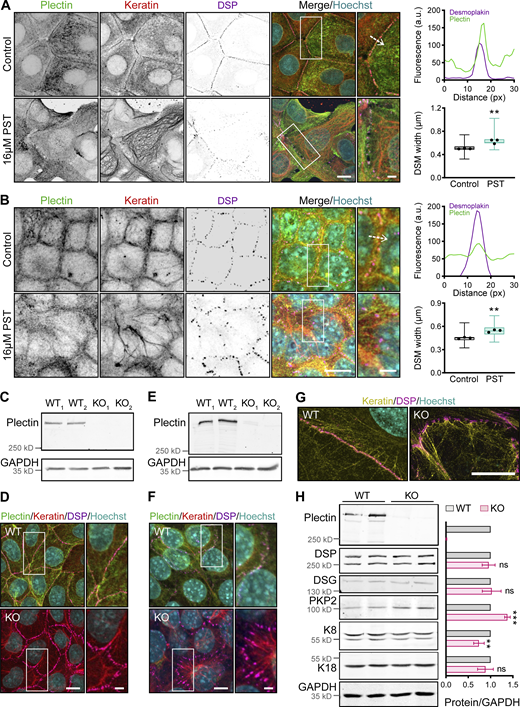 Inactivation of plectin disrupts the cytoarchitecture of KF–DSM networks in MDCK cells, cholangiocytes, and MCF-7 cells. (A and B) Representative confocal images of untreated (Control) and PST-treated (16 μM PST) monolayers of MCF-7 cells (A) and cholangiocytes (B) immunolabeled for plectin (green), keratin (red), and DSP (magenta). Nuclei, Hoechst (cyan). Dashed lines, line scans (upper right). Boxed areas, ×2 images. Scale bars, 10 and 3 μm (boxed areas). Graphs show line-scan analysis of DSP and plectin fluorescence intensities. Boxplots show the quantification of DSM widths (lower right). The box represents the 25th and 75th percentile with the median indicated; whiskers reach the last data point; dots, means of independent experiments; n (A) = 113 (Control), 93 (PST); n (B) = 92 (Control), and 81 (PST) DSMs; N = 3. Two-tailed t test; **, P < 0.01. (C and E) Immunoblots showing depletion of plectin in individual clones of KO MDCK cells (C) and cholangiocytes (E) generated with two alternative gRNAs (KO1 and KO2). (D and F) Representative confocal images of monolayers of WT and KO MDCK cells (D) and cholangiocytes (F) immunolabeled for plectin (green), keratin (red), and DSP (magenta). Boxed areas, ×2 images. Scale bar, 10 and 3 μm (boxed areas). (G) Representative SIM images of peripheral keratin structures in WT and KO MDCK monolayers immunolabeled for keratin (yellow) and DSP (magenta). Scale bar, 10 μm. (H) Quantification of plectin, DSP, DSG, PKP2, K8, and K18 in lysates from WT and KO monolayers by immunoblotting. GAPDH, loading control. The graph shows relative band intensities normalized to average WT values. Data are presented as mean ± SEM; N = 3–6. Two-tailed t test; **, P < 0.01; ***, P < 0.001, ns, P > 0.05. Source data are available for this figure: SourceData FS1.