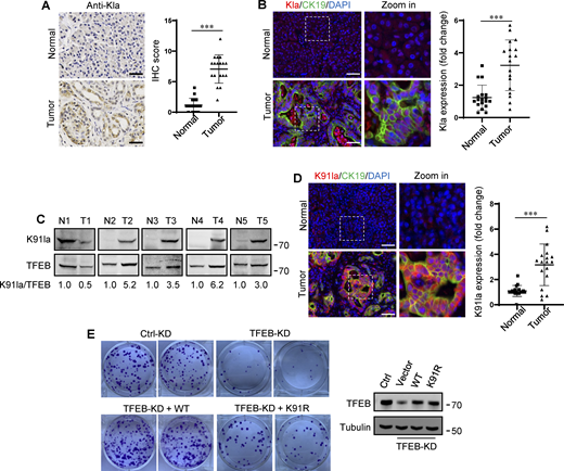 Upregulation of TFEB lactylation in pancreatic cancer. (A) Immunohistochemical (IHC) images of representative PDA (n = 18) and adjacent normal (n = 18) samples stained with anti-Kla. Scale bars, 10 μm. (B) Representative immunofluorescent images of PDA and normal tissues stained with anti-Kla and anti-CK19, and DAPI. Scale bars, 10 μm. (C) Lactylation of TFEB K91 in five pairs of PDA (T) and matched adjacent normal tissues (N). The specific K91la antibody was used for western blotting and the relative intensity ratios of the lactylated TFEB K91 band to the corresponding TFEB band are shown. (D) Representative immunofluorescent images of PDA and normal samples stained with anti-TFEB-K91la and anti-CK19. Scale bars, 10 μm. (E) In vitro colony-forming ability of PANC1 cells. Cells were transfected with Flag-tagged TFEB-WT or TFEB-K91R after TFEB RNAi and were stained with crystal violet 2 wk later. The expression of TFEB protein in these cells is shown. The quantitative data show relative whole-section expression of lactylated proteins (n = 18 samples) (A and B) and lactylated TFEB (n = 18 samples) (D). The data are presented as mean ± SEM. ***P < 0.001. All molecular weights are in kD. Source data are available for this figure: SourceData F7.