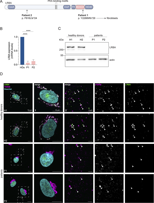 Distinct point mutations in the LRBA gene of two LRBA-deficient patients cause mRNA decay and loss of the protein. (A) Schematic of LRBA protein structure with annotated domains. The genetic mutations carried by the two LRBA-deficient patients investigated in this study are shown. Dermal fibroblasts obtained from these patients were used in this study. (B) LRBA mRNA levels in the two patient and two healthy donor (HD) fibroblast cell lines were determined by qRT-PCR. Mean and standard deviation are shown from n = 4 biological replicates; one-way ANOVA using Dunnett’s multiple comparison, ****P < 0.0001. (C) Immunoblot analysis of LRBA presence in fibroblasts of two HDs and two patient donors using polyclonal LRBA antibody and actin as a loading control. (D) Colocalization of LRBA and TGN46 in fibroblasts of HDs. LRBA is absent in patient-derived fibroblasts. Cells were fixed, immunostained with TGN46 and LRBA antibodies, and imaged using a confocal microscope. Squares show magnification of the perinuclear area (1) and the periphery (2). The labeling of the single channels represents the color of the channel on the merged image. H1: HD 1, H2: HD 2, P1: patient 1, P2: patient 2. Source data are available for this figure: SourceData F1. Refer to the image caption for details.