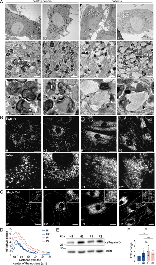 LRBA-deficient fibroblasts accumulate enlarged endolysosomes. (A) TEM analysis of accumulating endolysosomes in patient-derived cells. Squares show magnification of the endolysosomal structures. HDs showed electron-dense endolysosomes (black arrowheads). In contrast, in patient-derived cells, endolysosomes (black arrowheads) showed restricted degradative (electron-dense) domains (white arrowheads). Lysosomes (white star) and endosomes (black arrow) are shown. Two HDs and two patient-derived fibroblast lines were embedded and analyzed. Scale bar, 5 μm, inlays in the third row 1 μm. (B) Immunofluorescence analysis of accumulating, enlarged (endo)lysosomes in patient-derived cells. Fibroblasts were fixed with methanol and stained for LAMP1. Cell outlines are marked with a dashed line. Squares show magnification of the (endo)lysosomes. Representative confocal images are shown from n = 3 biological replicates. Scale bar, 20 μm, inlays 10 μm. (C) Analysis of cathepsin B activity in LRBA-deficient fibroblasts. LRBA-deficient patient-derived and healthy fibroblasts were plated onto imaging chambers and their lysosomes were visualized with Magic Red (indicating cathepsin B activity) and imaged live at 37°C, 5% CO2. Representative wide-field images are shown from n = 3 biological replicates. Cell outlines are marked with a dashed line. Squares show the magnified area. Inlays are shown in the top right corner of the images. Scale bar, 20 μm, inlays 2 μm. (D) Quantification of the MagicRed intensity along the nucleus-cell periphery axis. A line ROI was drawn from the nucleus to the cell periphery and Magic Red intensity was measured. Values were normalized to the maximum of each cell and averaged per experiment. The mean of three biological replicates is plotted along the axis; H1 = 45 cells, H2 = 53 cells, P1 = 51 cells, P2 = 49 cells were analyzed. (E) Western blot analysis of matured cathepsin D (heavy chain) protein levels in healthy and patient-derived fibroblasts using actin as a loading control. (F) Quantification of cathepsin D levels based on immunoblots shown on panel E from n = 4 biological replicates mean ± SD; one-way ANOVA using Tukey’s multiple comparison. Source data are available for this figure: SourceData F4.