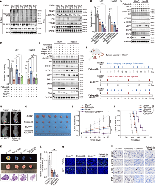 PC4 exhibits distinct modifications in HCC, and PC4 loss sensitizes HCC cells to CDK4/6 inhibitors. (A) Western blot showing the indicated protein expressions between six paired human HCC and adjacent tissue samples. N, normal. T, tumor. (B) Cell viability analysis by CCK8 assay in Huh7 and HepG2 cells treated with Palbociclib, siPC4, or a combination of Palbociclib and siPC4. Data are generated from n = 5 biological replicates. (C) Western blot shows the indicated protein expressions in Huh7 and HepG2 cells with Palbociclib, siPC4, or a combination of Palbociclib and siPC4. (D) Cell viability analysis by CCK8 assay in PC4-knockdown Huh7 and HepG2 cells treated with a combination of Palbociclib and PC4WT, PC4K68R, or PC4S17E. Data are generated from n = 5 biological replicates. (E) Western blot showing the indicated protein expressions in PC4-knockdown Huh7 and HepG2 cells treated with a combination of Palbociclib and PC4WT, PC4K68R, or PC4S17E. (F) Schema for Palbociclib, CLANsiPC4, or combination of Palbociclib and CLANsiPC4-treated Huh7-Luc xenografts model. (G) Bioluminescence from Huh7-Luc xenografts mice treated in F. (H) Photograph of tumors from Huh7-Luc xenografts mice treated in F. (I) Quantification of the tumor volume in Huh7-Luc xenografts mice treated in F. Data were generated from n = 6 in each group. (J) Overall survival from Huh7-Luc xenografts mice treated in F. Data are generated from n = 9 in each group. (K) Bioluminescence (top), photographs (middle), and H&E staining (bottom) of lungs from CLANNC, Palbociclib, CLANsiPC4, or Palbociclib+CLANsiPC4-treated Huh7-Luc xenografts mice. Scale bar = 1 mm. (L) Quantification of metastatic lesions to lung in K. Data are generated from n = 6 in each group. (M) Tunnel and Ki67 staining from Huh7-Luc xenografts mice treated in F. Data are generated from n = 6 in each group. Scale bar = 75 μm. (N) Representative images of CCND1, p-CDK2, p-RB, and CCND1 immunostaining from Huh7-Luc xenografts mice treated in F. Scale bar = 20 μm. Data are generated from n = 6 in each group. All quantifications are shown as means ± SD (one-way ANOVA test); error bars represent SD. **P < 0.01, ***P < 0.001, ****P < 0.0001. A, C, and E are representative of three independent experiments. Source data are available for this figure: SourceData F7.
