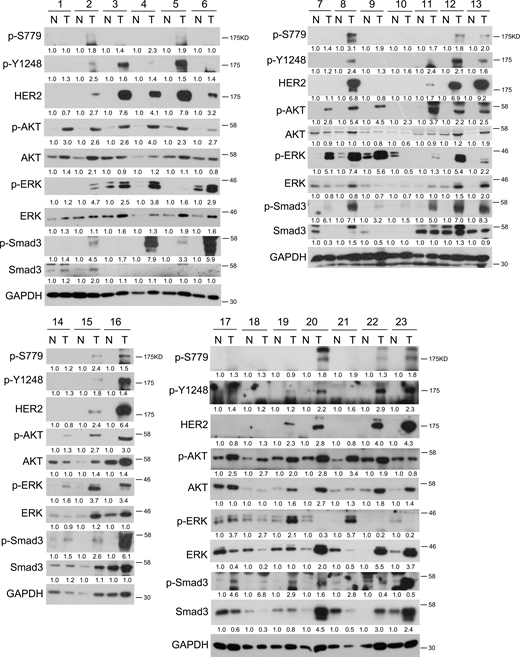 High levels of HER2 S779 phosphorylation are detected in breast cancer samples. 23 pairs of breast cancer samples (T) and their adjacent normal tissues (N) were harvested for immunoblotting. Sample 1 and 9 are triple-negative breast cancer; Sample 10 and 18 are Luminal A subtype of breast cancer; Sample 2, 4, 7, 11, 12, 15, 17, 20, 21, and 22 are Luminal B subtype of breast cancer; Sample 3, 5, 6, 8, 13, 14, 16, 19, and 23 are HER2-positive breast cancer. The band intensity of phosphorylated proteins was normalized to total proteins. The band intensity of total proteins was normalized to GAPDH. Source data are available for this figure: SourceData FS5.