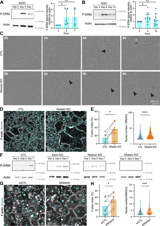 Moesin KO increases the fusion capacities of mOCs and hOCs. (A) Western blot analysis of activated ERM (P-ERM) expression level during mOC differentiation (days 3, 5, and 7); actin was used as loading control and quantification of P-ERM level was normalized to actin. Each circle represents an independent experiment, means ± SD are shown, n = 5. (B) Same experiment as in A during hOC differentiation (days 3, 6, and 10). Each circle represents a single donor, means ± SDs are shown, n = 9. (A and B) Predicted molecular weight are indicated. n.s. not significant. (C) Reprensentative bright-field microscopy images from a time-lapse movie of control (CTL) and moesin KO mOC (moesin KO) on day 4 of differentiation. Black arrowheads point to multinucleated giant osteoclasts. See Video 6. Scale bar, 100 µm. (D and E) Microscopy analysis of cell fusion in control (CTL) and moesin KO mOC. (D) Representative microscopy images: F-actin (phalloidin, white) and nuclei (DAPI, cyan). Scale bar, 200 µm. (E) Quantification of fusion index (each circle represents an independent experiment, n = 6); and nuclei number per multinucleated osteoclast (150–250 cells/condition, n = 3 independent experiments). (F) Representative western blot analysis of P-ERM expression level in control (CTL), ezrin KO, radixin KO, and moesin KO mOC; actin was used as loading control, n = 2. Predicted molecular weight is indicated. (G and H) Microscopy analysis of hOC fusion after treatment with nontargeting siRNA (siCTL) or siRNA targeting moesin (siMoesin). (G) Representative microscopy images: F-actin (phalloidin, white) and nuclei (DAPI, cyan). Scale bar, 100 µm. (H) Quantification of fusion index (each circle represents a single donor, n = 8) and nuclei number per multinucleated osteoclast (one representative experiment from 8 donors is shown, 100–200 cells/condition). Statistical analyses: (A and B) Friedman and then Dunn’s multiple comparison tests. *P ≤ 0.05; n.s., not significant. Source data are available for this figure: SourceData F2. Refer to the image caption for details.
