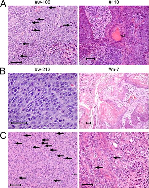 Figure 3. In vivo tumor formation by p53 KO+3F and p53R172H+3F clones and by Klf4-overexpressing p53 KO and p53R172H MEFs. (A, Left) A representative hematoxylin and eosin (H&E) section obtained from a typical sarcoma generated by a p53 KO+3F clone (#w-106). Arrows point at cells undergoing mitosis. (A, Right) A representative section of clone #110 that formed a sarcoma, within which were rare foci of keratin (arrowhead). Shown are representative sections out of 10 tumors that were analyzed. (B) Sarcoma (left) and a tumor containing large differentiated regions of keratin (right) generated by p53R172H+3F-reprogrammed clones (#w-212 and #m-7, respectively). Shown are representative sections out of nine tumors that were analyzed. (C) Typical sarcomas generated by Klf4-overexpressing p53 KO MEFs (left) and p53R172H MEFs (right). Arrows point at mitotic figures. Shown are representative sections out of two tumors analyzed for each cell type. The exact numbers of total tumors analyzed out of each representative clone are summarized in Table S1. Bars, 50 µm.
