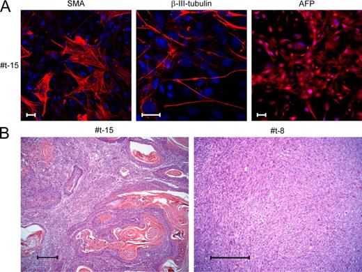 Figure 6. p53R172H cells reprogrammed with Oct4 and Sox2 lose their differentiation capacity in vivo. (A) In vitro differentiation into cells of the three germ layers of a representative p53R172H+2F clone (#t-15). Markers used are described in Fig.1 C. Bars, 25 µm. A representative experiment out of two is shown. (B) Representative sections obtained from tumors formed by p53R172H+2F clones. Left, a sarcoma containing large regions of ectodermal differentiation (#t-15). Right, a sarcoma without any differentiation (#t-8). Bars, 100 µm. Shown are representative sections out of eight tumors that were analyzed. The exact numbers of total tumors analyzed out of each representative clone are summarized in Table S1.