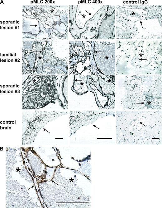 Figure 4. KRIT1 haploinsufficiency increases ROCK activity in human cerebral lesion endothelium. (A) Human CCM cerebral lesions were compared with nonlesion control brain tissue. Slides were processed as described in Materials and methods, stained with anti-pMLC as an index of ROCK activation, and counterstained with hematoxylin. Control antibody stains are with rabbit IgG. The left and center columns are stained for pMLC, and the right column is stained with control antibody. Bars, 500 µm. The CCM lesions are clusters of distended capillaries lacking SMC underlayer. Arrows indicate cavern endothelial cells; asterisks mark lumen of a typical expanded lesion vessel. The control non-CCM brain tissue panel shows an arteriole in cross section, exhibiting pMLC in SMC subendothelial layer, but little in endothelial cells (arrow) facing vessel lumen. Sporadic lesion #1 is KRIT1 protein deficient (Fig. S3). Familial lesion #2 is CCM2 deficient (Fig. S3) and has equally robust endothelial pMLC staining. (B) Magnified view of familial lesion #2 endothelium.