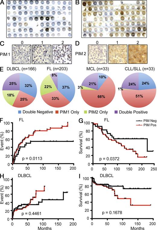 Figure 1. PIM kinase expression affects the outcome of lymphoma therapy. (A and B) DLBCL TMAs stained for PIM1 (A) and PIM2 (B). (C and D) Representative tumor cores for each PIM histology score (0–2). (E) Pie graphs showing breakdown of PIM1/2 TMA scores by disease; see also Table S1. (F) TTE analysis after primary therapy in follicular lymphoma (n = 66). (G) OS analysis from date of diagnosis in follicular lymphoma. (H and I) TTE (H) and OS (I) in DLBCL (n = 116).