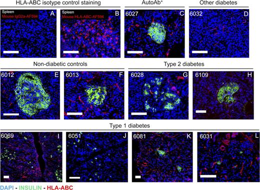 Figure 1. Histopathological survey of diabetic donors and controls for insulin (green) and MHC class I (red) expression. (A and B) Positive control staining for HLA-ABC on human spleen section and parallel isotype-matched negative control staining. (C) Nondiabetic individual with autoantibodies against ZnT8. (D) Case of undefined diabetes. (E and F) Nondiabetic donors. (G and H) Type 2 diabetics. (I and L) Longstanding T1D cases without HLA class I hyperexpression. All case numbers correspond to Table S1. Bars, 100 µm.