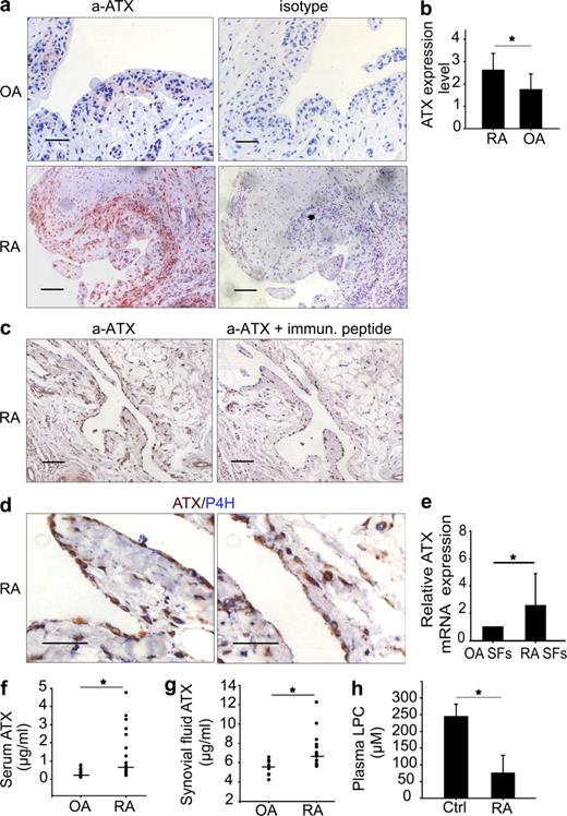 Figure 3. Increased ATX expression in RA patients. (a) Representative sections from RA and OA synovial tissues stained for ATX or isotype IgG control. (b) The expression of ATX from tissues shown in a was quantified as described in Materials and methods (n = 8). (c) ATX staining upon the addition of the immunogenic blocking peptide. (d) Representative double staining of human RA tissue section for ATX and P4H. (e) Real-time PCR analysis of ATX expression in SFs isolated from subjects with OA or RA (n = 3). (f) Measurement of ATX levels in sera from RA and OA patients (n = 26). Personal and clinical patient information is included in Table S1. (g) Measurement of synovial fluid ATX levels with ELISA from RA and OA patients (n = 16 and 9, respectively). (f and g) Values are expressed as medians, and statistical significance was assessed using the Mann-Whitney Rank Sum test. Asterisks indicate a statistically significant (*, P < 0.05) increase. (h) Measurement of (total) LPC plasma levels with LC/MS in RA patients and healthy controls (Ctrl; n = 5). (b, e, and h) Mean ± SE is shown. *, P < 0.05. Bars, 50 µm.