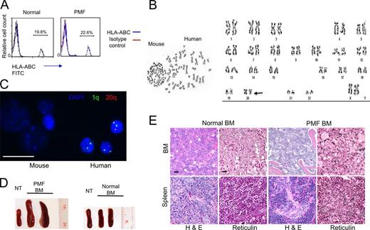 Figure 7. Engraftment of human PMF BM–derived cells in NSG mice. (A) Representative flow cytometry plot of PB from NSG mice injected with normal human or PMF BM–derived low-density cells showing the presence of cells carrying the HLA-ABC antigen. PB cells were assessed 14 d after injection of BM cells and approximately every 2–4 wk thereafter to confirm the mouse–human chimerism. Approximately the same level of HLA-ABC–positive cells was detected throughout the animal’s life (Table S4). (B) Karyotype (Giemsa banding) analysis of BM cells obtained from NSG mice injected with PMF BM–derived low-density cells. The arrow indicates the 20q deletion in the human cells. (C) FISH analysis of BM cells from xenograft mice using probes specific for 20q and 1q (internal control). DAPI nuclear staining is shown in blue. Both mouse and human cells are depicted. Bar, 10 µm. (D) Mouse spleens 3 mo after injection of PMF or normal BM low-density cells. Spleens from nontransplanted (NT) mice are shown for comparison. (E) H&E and reticulin staining of BM (femur) and spleen sections of mice injected with normal or PMF BM low-density cells. Notable features in PMF include atypical megakaryopoiesis anisocytosis, abnormal large nuclear/cytoplasmic ratio, hyperchromatic nuclei, and plump lobulation of the nuclei. Reticulin-stained BM sections from mice injected with PMF BM cells shows increased reticulin fibrosis. In contrast, in mice injected with normal BM cells, hematopoiesis is unaltered, splenic architecture is preserved, and no significant reticulin fiber deposition is observed. Images are representative of 10 mice injected with normal BM cells and 10 injected with PMF BM cells. The fibrosis grade ranged from MF-2 to MF-3 in PMF BM–injected mice, and no fibrosis was seen in any of the normal BM–injected mice. Bars: (H&E) 100 µm; (reticulin) 50 µm.