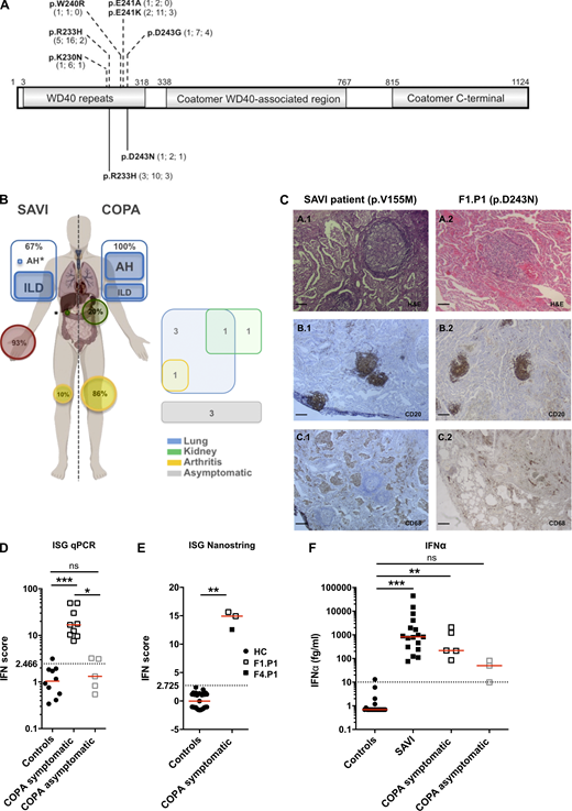 Heterozygous mutations in COPA, comparison of COPA syndrome and SAVI, and constitutive activation of the type I IFN pathway in patients.(A) Schematic representation of COPA adapted from Watkin et al. (2015) highlighting the WD40 repeat domain, the coatomer WD40-associated region, and the coatomer C-terminal region. Previously reported mutations (Watkin et al., 2015; Noorelahi et al., 2018; Patwardhan and Spencer, 2019) are shown above (p.K230N, p.R233H, p.W240R, p.E241K, p.E241A, and p.D243G). The mutations carried by the patients in this study are shown below (previously reported p.R233H and newly described p.D243N). Numbers in brackets refer to the number of families identified, mutation carriers, and asymptomatic individuals, respectively. (B) Comparison of the clinical phenotypes of SAVI and COPA syndrome according to published data (left, and see Table S2), and features present in the patients of this study (right). Lung, kidney, skin, and joint involvement are represented in blue, green, red, and yellow, respectively. AH, alveolar hemorrhage; asterisks represent a single patient reported in the literature (Volpi et al., 2019; Tang et al., 2020). (C) Comparison of histopathological features of the lung of a patient with SAVI carrying a p.V155M mutation in STING (Jeremiah et al., 2014; left) and F1.P1 (right). H&E staining showing lymphoid follicles (A.1 and A.2). Immunohistochemical staining identified a majority of CD20+ B cells within the B cell follicles (B.1 and B.2), and macrophage (CD68+) alveolar infiltration in the SAVI patient (C.1), and the presence of rare macrophages (CD68+ cells) within the alveoli of F1.P1 (C.2). Original magnification: ×40 (A; scale bars, 100 µm), ×10 (B and C; scale bars, 400 µm). (D) IFN scores calculated from the median fold change in relative quantification values for a set of six ISGs (Rice et al., 2013; IFI27, IFI44L, IFIT1, ISG15, RSAD2, SIGLEC1; normal <2.466) recorded in patients, as compared with 10 HCs. Red lines indicate median values. Median values in symptomatic patients (n = 9 samples from five individuals; 16.87; IQR, 9.953–39.73) were significantly higher than in HCs (1.045; IQR, 0.5225–1.870; ***, P= 0.0002), whereas median values in asymptomatic carriers (n = 5 samples from three individuals; 1.319; IQR, 0.6865– 3.179) were comparable to HCs (by Kruskal–Wallis test). One asymptomatic carrier (F2.P2) displayed a mildly positive IFN signature on two occasions (IFN scores above the dotted line). (E) IFN scores calculated from the median fold change in relative quantification values for a set of 24 ISGs (see Materials and methods and Table S4, normal <2.725) recorded in the peripheral blood of F1.P1 (sampled twice, depicted as open squares) and F4.P1 (depicted as a black square), as compared with 27 HCs (depicted as circles). Red lines indicate median values. Data were statistically analyzed using the Mann–Whitney test (**, P < 0.01). (F) Concentrations of IFN-α protein assessed by ultra-sensitive digital ELISA (Rodero et al., 2017) in plasma or serum from HCs (n = 20, <10 fg/ml), and patients with mutations in TMEM173 encoding STING (n = 17 samples from nine SAVI patients) or COPA (n = 5 samples from five symptomatic patients and n = 3 samples from two asymptomatic carriers). Red lines indicate median values of 817.8 fg/ml (IQR, 275–3,039), 217.7 fg/ml (IQR, 148–1,658), and 49.61 fg/ml (IQR, 9.809–81), respectively, in SAVI patients, COPA symptomatic patients, and asymptomatic carriers. Data were statistically analyzed using the Kruskal–Wallis test (**, P < 0.01; ***, P < 0.0001; ns, not significant).