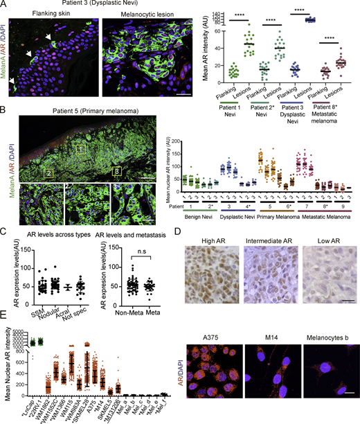 AR expression in melanoma cells. (A) Representative images and quantification of AR expression in cells of melanocytic lesions versus melanocytes of flanking normal skin (stars) by double IF with antibodies against AR (red) and MelanA (green) for melanocyte identification. DAPI was used for nuclear localization (blue). Shown are AR fluorescence signal intensity in arbitrary units (AU) per individual cells together with mean and statistical significance. MelanA-positive cells, n ≥ 25, unpaired t test, ****, P < 0.001. Samples from male patients in this and following panels are indicated by asterisks. (B) Left: Double IF staining of a primary melanoma lesion and topographically distinct areas (boxes 1, 2, and 3) analyzed for single-cell AR expression. Scale bars: 500 and 50 µm, respectively. IF images of cells in this and other lesions are shown in Fig. S2. Right: Quantification of nuclear AR fluorescence signal in individual MelanA-positive cells (dots) from three topographically delimited areas per melanocytic lesion of different patients. Fluorescence intensity AU values per individual cells are indicated together with the mean. MelanA-positive cells, n ≥ 50, unpaired t test, ****, P < 0.001. (C) Quantification of AR fluorescence signal in MelanA-positive cells in a tissue microarray of different melanoma lesions (left) and metastatic and nonmetastatic forms (right). SSM, superficial spreading melanoma; acral, acral lentiginous melanoma. Quantification was based on digitally acquired images of three independent fields per lesion (≥50 cells per field), with averaged values per individual lesion shown together with mean. Quantification of samples divided by sex and age of patients is provided in Fig. S1 E. Patient sample details provided in Table S1. n.s, not significant. (D) Immunohistochemical staining with anti-AR antibodies of melanomas with high versus intermediate and low AR expression as assessed by double IF analysis in A. Scale bar: 30 µm. Lower-magnification images with MelanA staining of parallel sections are shown in Fig. S1 F. (E) Quantification and representative images of nuclear AR expression by IF analysis of the indicated melanoma cell lines or primary melanoma cells versus primary melanocytes (Mel a-f), and prostate cancer cell lines (LnCAp, 22RV.1) examining >100 cells per sample. Shown are individual cells values (dots) together with mean ± SD. Scale bar: 10 µm. Additional images of cells are shown in Fig. S1 G.