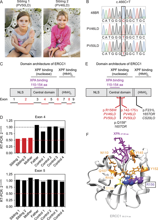 Two siblings with ERCC1 deficiency.(A) Picture of the siblings PV50LD (left) and PV46LD (right). (B) Sanger sequencing of a region in the ERCC1 gene from genomic DNA of the indicated cell lines. See Fig. S2 A for additional NGS data on the ERCC1 missense variant. (C) Schematic representation of the exons in the ERCC1 gene mapped onto the domains in the ERCC1 protein. (D) Multiplex real-time qPCR results on genomic DNA extracted from lymphocytes or epithelial cells from which regions in exon 4 or exon 5 of the ERCC1 gene were amplified (see Table S1). Exon 27 of the CFTR gene was used as an internal standard. The 2-(ΔΔCt) values are shown for the indicated individuals. All values are based on technical triplicates. The black line indicates the expected value when two functional copies of the indicated ERCC1 exon are present, while the red line indicates the expected value when only a single copy is present due to an intragenic deletion on the other allele. See Fig. S2 B for additional NGS data on the intergenic ERCC1 deletion. (E) Schematic representation of domains in the ERCC1 protein with known patient mutations. (F) Structure of the ERCC1 central domain bound to a short XPA peptide. Residues that line the XPA-binding pocket (R106, Q107, N110, Y145, and Y152) or that form a salt bridge just below this pocket (R156 and D129) are indicated. The R156 residue is substituted for W in the siblings.