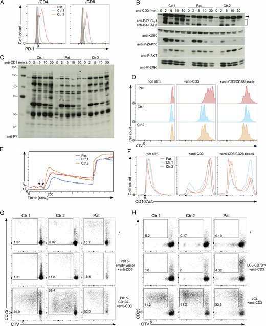 Functional characterization of T cells from the patient. (A) FACS histograms of PD-1 gated on CD4 and CD8 memory T cells from PBMCs from two control donors (Ctr.1 and Ctr.2) and the CD137L-deficient patient (Pat.). Isotype control in gray. (B and C) Analysis of TCR signaling in T cell blasts from two controls donor (Ctr.1 and Ctr.2) and the CD137L-deficient patient (Pat.).Immunoblots showing the phosphorylation of proximal signaling molecules after stimulation with anti-CD3 antibodies for 0, 2, 5, 10, and 30 min. (B) Cell lysates immunoblotted with antibodies against phospho-PLC-Ɣ1 (P-PLC-Ɣ1), phospho-ERK1/2 (P-ERK), phospho-AKT (P-AKT), phospho-ZAP-70 (P-ZAP70), NFAT2 and KU80 as a loading control. Anti–P-PLC-Ɣ1 and anti-NFAT2 were tested on the same membrane. Data representative of three experiments. (C) Cell lysates immunoblotted with antibodies against tyrosine phosphorylated residues to analyze global tyrosine phosphorylation signals. Data representative of three experiments. (D–F) Analyses of T cell responses of T cell blasts from two controls (Ctr.1 and Ctr.2) and the patient (Pat.). (D) FACS histograms showing T cell blast proliferation profiles determined by dilution of CTV in response to immobilized anti-CD3 antibody at the indicated concentrations or anti-CD3/CD28–coated beads. Data representative of two experiments. (E) Flow cytometry analyses of Ca2+ flux in T cell blasts loaded with the Ca2+-sensitive fluorescent dye Indo1. Cells then stimulated with anti-CD3 (first arrow) crosslinked with rabbit anti-mouse (second arrow). Intracellular Ca2+ levels expressed in AU. Data representative of two experiments. (F) Degranulation of CD8+ T cell blasts stimulated with the indicated concentrations of anti-CD3. Cells stained with antibodies against CD107a/b (LAMP1/2), a surface-exposed marker of the secretion of lytic granules. Data representative of two experiments. (G and H) FACS dot-plots of CD137-dependent (G) or CD70-dependent (H) proliferation assays of PBMCs labeled with the CTV dye and cocultured in G with irradiated P815 cells expressing WT CD137L or an empty vector or in H with irradiated LCL cells expressing CD70 (LCL) or not (LCL-CD70neg). Irradiated LCL and P815 cells were preincubated with anti-CD3 antibody (+anti-CD3) before being added to the PBMCs. Non-stimulated PBMCs were cultured without irradiated LCL or P815 cells. Staining with anti-CD25 antibody. CD25 as activation marker and gating on CD3+ T cells. Proliferating T cells in the gates and numbers indicating proportions of cells in the gates. (G and H) Data representative of two experiments. Source data are available for this figure: SourceData FS1.