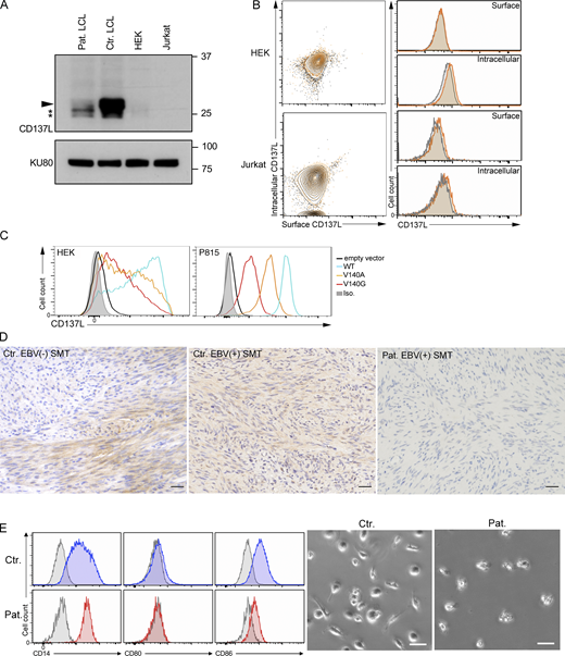 The V140G mutation (CD137LV140G) results in decreased CD137L expression in patient cells and impaired reversed signaling in patient monocytes. (A) WBs of lysates from LCLs of one control (Ctr. LCL), LCLs of the patient (Pat. LCL), HEK, and Jurkat cell lines. CD137L is indicated by a plain arrowhead and immature/degraded CD137L products by asterisks (*). Anti-KU80 antibody as the loading control (lower blot). Size markers (in kD) on the right. (B) Surface and intracellular CD137L expression in HEK and Jurkat cells. Dot-plots and FACS histograms with CD137L staining in yellow/orange and isotype controls in gray. (C) FACS histograms of CD137L expression in HEK 293-T (left) and P815 cells (right) ectopically expressing WT CD137L, the mutant CD137L V140A and V140G proteins, or transfected with an empty vector. (D) Analysis of CD137L expression on EBV+ and EBV− SMT tissues of two individuals and the patient (Pat.). Magnification ×400, scale, 40 μM. Similar findings with two EBV+ and two EBV− SMT tissues from different individuals. (E) Analysis of CD137L reverse signaling in CD14+ monocytes of one healthy control (Ctr.) and the patient (Pat.) that were treated with CD137-Fc protein for 7 d, and surface markers were analyzed by flow cytometry (left panels). Enhanced CD86 and CD80 and decreased CD14 expression in treated control monocytes are characteristics of monocytes differentiating into DCs. Cells from a control showed spindle shaped morphology associated with DC differentiation (right panels). Scale, 50 μM. (A) One representative experiment of four. Source data are available for this figure: SourceData FS2. Refer to the image caption for details.