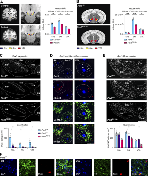 PAX5 deficiency causes hypoplasia of the SN and VTA with loss of GABAergic neurons. (A) Left: Coronal MRI brain scans of the patient and a representative control. The SNr (blue), SNc (yellow), and VTA (red) are indicated. Right: Volumetric quantification of the three midbrain regions. (B) Left: Coronal MRI brain scans of adult Pax5+/+ and Pax5R31Q/− mice. Right: Quantification of the three midbrain regions. (C) Top: Anti-Pax5 staining (white) of Pax5+/+, Pax5+/−, and Pax5R31Q/− adult mouse brain sections. Dotted lines delineate the SNr, SNc, VTA, and interpeduncular nucleus (IPN). Bottom: Quantification of Pax5-expressing cells. (D and E) smRNA-FISH staining. (D) SN- and VTA-containing section of an adult wild-type mouse with Pax5 (white), Rbfox3 (red), Gad1/Gad2 (green), and DAPI (blue) staining. Data are representative of three experiments. Dotted lines delineate cell boundaries demarcated by Gad1/Gad2 mRNA staining. (E) Top: Gad1/Gad2 mRNA (white) of Pax5+/+, Pax5+/−, and Pax5R31Q/− adult mouse brains. Dotted lines delineate SNr, SNc, VTA, and IPN. Bottom: Quantification of Gad1/Gad2-expressing cells (n ≥ 3 mice per indicated genotype). (F) Immunofluorescent staining of coronal sections of an adult wild-type midbrain with antibodies detecting tyrosine hydroxylase (TH; green) and Pax5 (red) in combination with DAPI (blue). The data are representative of three experiments with different wild-type mice. Scale bars: 500 μm (C and E); 10 μm (D); 20 μm (F). RU, relative units. Data (A–C and E) are shown as mean values with SEM (n = 5 for controls in A, n ≥ 4 per genotype for B, and n ≥ 3 per genotype for C and E). Two-tailed one-sample t test with false discovery rate (FDR) correction (A), unpaired t test with FDR correction (B), ANOVA with Dunnett’s multiple comparisons test (C and E); *, P < 0.05; **, P < 0.01; ***, P < 0.001; ****, P < 0.0001. For detailed statistical information (A–C and E), see Table S6. Each dot represents one individual (A) or a single mouse (B, C, and E).