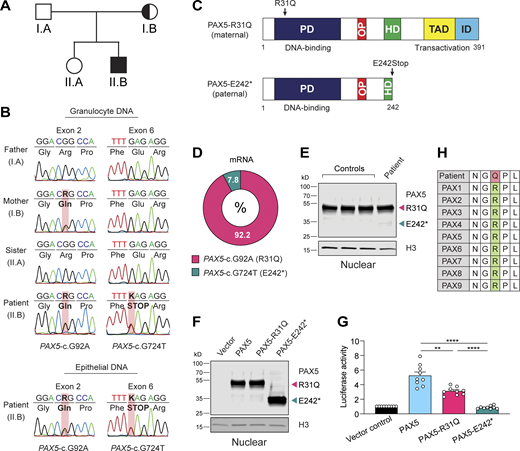 Identification of a patient with biallelic PAX5 mutations. (A) Family pedigree of the 19-yr-old patient (II.B) with his asymptomatic mother (I.B). (B) Chromatograms of Sanger sequencing showing segregation of the PAX5-c.G92A (left) and PAX5-c.G724T (right) mutations in the four family members. PCR-amplified DNA from granulocytes was analyzed. In addition, PCR analysis was performed with DNA from epithelial cells of the patient (II.B). R (G + A); K (G + T). (C) PAX5 domain organization. The two mutations on the maternal and paternal PAX5 alleles are indicated together with the paired domain (PD), octapeptide motif (OP), partial homeodomain (HD), transactivation domain (TAD), and inhibitory domain (ID; Dörfler and Busslinger, 1996). (D) Abundance of PAX5-c.G92A and PAX5-c.G724T mRNAs in naive mature B cells of the patient. The frequency of the mutant mRNAs was determined by RT-qPCR amplification and subsequent sequencing of the cloned PCR fragments. (E) Immunoblot analysis of nuclear extracts from EBV-immortalized B cells of the patient and three controls with anti-PAX5 and anti-H3 antibodies. The positions of the full-length PAX5-R31Q and truncated PAX5-E242* proteins are indicated. (F) Expression of wild-type PAX5, PAX5-R31Q, and PAX5-E242* proteins in nuclear extracts of transfected HEK-293T cells, analyzed by immunoblotting with anti-PAX5 and anti-H3 antibodies. (G) Analysis of the transactivation potential of the wild-type and mutant PAX5 proteins in HEK-293T cells, transfected with the indicated PAX5 expression vectors, the plasmid lucCD19 containing three high-affinity PAX5-binding sites upstream of the β-globin TATA box and initiator region linked to the firefly luciferase gene (Czerny and Busslinger, 1995), and a control renilla luciferase plasmid. The firefly and renilla luciferase activities were measured 2 d after transfection. Normalized firefly activity is shown relative to the pcDNA3.1 vector control (set to 1). The pooled data of three independent experiments (each dot corresponding to one transfection assay; n = 9 for each expression vector) are shown as mean values with SEM analyzed by ANOVA with Dunnett’s T3 multiple comparison test; **, P < 0.01; ****, P < 0.0001. For detailed statistical information, see Table S6. (H) Evolutionary conservation of arginine (R) at position 31 in all human PAX proteins; remaining amino acids are abbreviated as follows: asparagine (N), glycine (G), glutamine (Q), proline (P), leucine (L). Refer to the image caption for details.