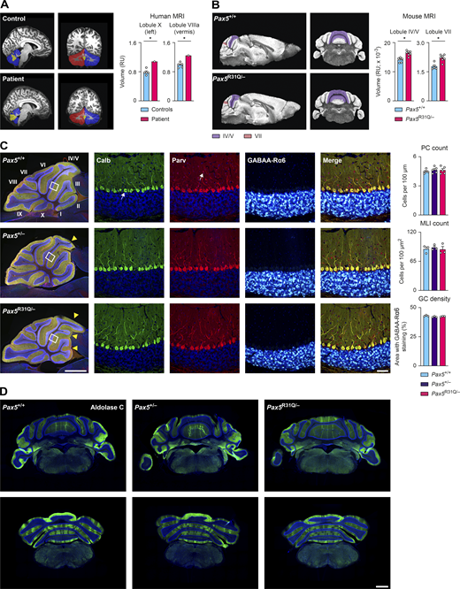 PAX5 deficiency causes aberrant foliation of the cerebellum. (A) Left: Sagittal and coronal MRI brain scans of the patient and a representative control. The left (blue) and right (red) hemispheres and the vermis (yellow) of the cerebellum are indicated. Right: Volumetric quantification of the lobules X (left hemisphere) and VIIIa (vermis) of the patient and five controls. (B) Left: Sagittal and coronal MRI brain scans of adult Pax5+/+ and Pax5R31Q/− mice. Right: Quantification of lobules IV/V and VII. (C) Immunofluorescent staining of sagittal brain sections from adult mice of the indicated genotypes. Left: The entire section of the cerebellum is shown after combined the staining with antibodies detecting calbindin (Calb, green), parvalbumin (Parv, red), and GABAA-R6α (white) together with DAPI (blue). The different lobules of the vermis are indicated by roman numbers. The altered foliation pattern in the vermis of Pax5+/− and Pax5R31Q/− brains is shown by yellow arrowheads. The scale bar denotes 1 mm. Center: Magnification of the inset regions shown in the overview sections (to the left) displays the individual staining of calbindin (arrow pointing to an individual Purkinje cell), parvalbumin (arrow pointing to an individual molecular layer interneuron), and GABAA-R6α (white) in combination with DAPI (blue). All stainings are merged in the image shown to the right. The scale bar denotes 50 μm. Right: Bar graphs show the density (cell numbers across monolayer or across area, respectively) of Purkinje cells (PC; calbindin expression), molecular layer interneurons (MLI; parvalbumin expression), and granule cells (GC; GABAA-R6α expression) in lobule IV/V (data obtained from midline sections of three mice per genotype for the GC and MLI quantification and five mice per genotype for the PC quantification). (D) Coronal cerebellar sections of adult mice of the indicated genotypes stained with an aldolase C–specific antibody (green) combined with DAPI (blue). One of three experiments is shown (n = 3 per genotype). Scale bars denote 1 mm (C, overview); 50 μm (C, magnification); and 1 mm (D). The data (A–C) are shown as mean values with SEM (n = 5 for controls in A, n ≥ 5 per genotype in B and n ≥ 3 per genotype in C). Two-tailed one-sample t test (A), unpaired t test with false discovery rate correction (B), ANOVA with Dunnett’s multiple comparisons test (C); *, P < 0.05. For detailed statistical information (A–C), see Table S6. Each dot represents one individual (A) or a single mouse (B and C). Refer to the image caption for details.