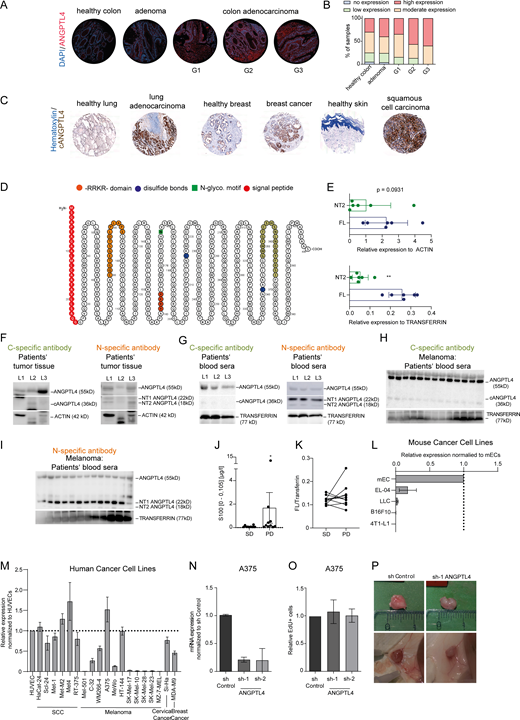 Tracing and characterizing the functional role of ANGPTL4 in clinical and preclinical settings. (A) Representative IF images of healthy colon, adenoma, and different grades of colon adenocarcinoma tissue sections (G1, G2, and G3) stained with ANGPTL4 antibody. (B) Quantification of no, low, moderate, and high ANGPTL4 protein expression in healthy colon (n = 20), adenoma (n = 25), and different grades of colon carcinoma (n = 69) tissue sections. (C) Representative stitched tile scanned IHC images of lung adenocarcinoma, breast cancer, cSCC, and corresponding healthy tissue sections stained with ANGPTL4 antibody. (D) Schematic illustration of the amino acid sequence of ANGPTL4. The protein sequence was visualized with the Protter software. (E) Graphs showing the densitometry quantitation of the Western blots from Fig. 1, E and G. Protein levels were normalized to actin in melanoma tumors and to transferrin in patients’ sera (n = 6; mean ± SD). **, P < 0.01, Mann–Whitney U test. (F and G) Western blotting with a cANGPTL4-specific antibody and an nANGPTL4-specific antibody in indexed lung cancer tumors and serum samples (n = 3). (H and I) Western blotting of melanoma patients’ sera with a C-specific antibody (I) and an N-specific antibody (n = 13). (J) Quantitation of S100 levels in melanoma patients’ sera with either stable disease (SD) or progressive disease (PD) diagnosis (n = 10; mean ± SD). *, P < 0.05, Mann–Whitney U test. (K) Densitometric quantitation of protein levels of Western blots (Fig. 2 C) was performed with Fiji. The graph shows the NT2/ANGPTL4 ratio normalized to transferrin in patients’ sera with either stable disease (SD) or progressive disease (PD) diagnosis (n = 10). (L and M) A systematic screen of the endogenous ANGPLT4 levels in different murine (L) and human (M) tumor cell lines analyzed by RT-qPCR (n = 3; mean ± SD). (N)ANGPTL4 expression in control and ANGPTL4 knockdown A375 tumor cell line quantified by RT-qPCR (n = 2; mean ± SD). (O) Quantitation of cellular proliferation of A375 sh Control and shANGPTL4 analyzed by EdU flow cytometry assay (n = 4; mean ± SD). (P) Representative images of size-matched A375 sh Control and shANGPTL4 tumors at the time of excision. Source data are available for this figure: SourceData FS2.