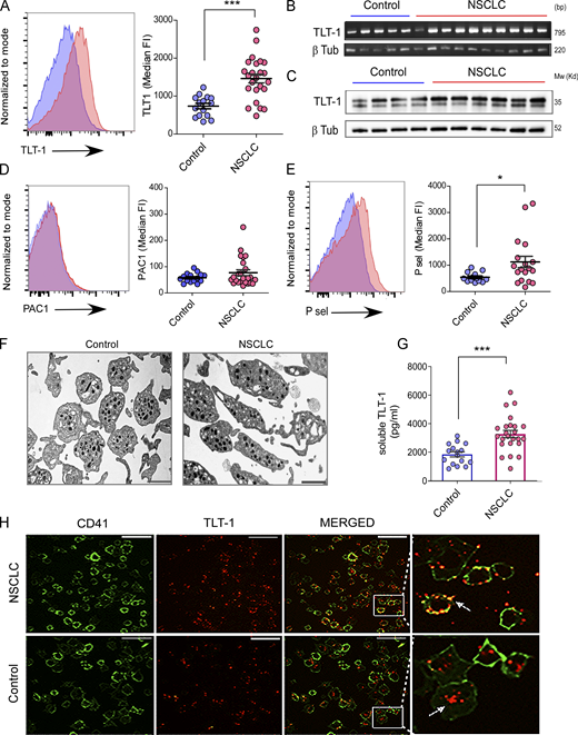 Human NSCLC platelets express and release elevated TLT-1 and display a distinct phenotype. (A) Representative FC histograms of isolated platelets from NSCLC patients and controls for surface TLT-1 (n = 24 for NSCLC, n = 15 for control), with their respective quantitation of median fluorescence intensities (Median FI) in the right panel (statistical significance tested by Mann–Whitney test). (B) Platelet TLT-1 mRNA levels in controls and NSCLC patients shown as the respective RT-PCR bands on agarose gel (upper panel); the band size is indicated by bp. (C) The immunoblot images show comparison of TLT-1 total protein expression in platelets from controls or NSCLC patients on Western blot, with β-tubulin (β-tub) as loading control as shown. (D) Representative FC histograms (left) of isolated platelets from NSCLC patients and controls for surface activation receptor (αIIb-β3), and respective quantitation (right) measured by PAC1 assay (n = 24 for NSCLC, n = 15 for control). Statistical significance tested by Mann–Whitney test. (E) P-sel surface expression with representative FC pseudocolor plots (left) and quantitation (right) of washed platelets from NSCLC patients and controls (n = 15 for control and n = 24 for NSCLC). Statistical significance tested by Mann–Whitney test. (F) Representative transmission EM micrographs for control and NSCLC platelets (n = 4 in each group) shown (scale bar, 1 µm) from samples from each group. The washed platelets were fixed and negatively stained as described in methods. (G) Quantitation soluble TLT-1 in plasma in control (blue) and NSCLC groups (statistical significance tested by Mann–Whitney test). (H) Activated and adhered platelets from NSCLC or control groups as observed by confocal microscopy showing TLT-1 being released by NSCLC platelets. Representative micrographs are shown with zoomed in portion of merged image on the extreme right. The scale bar represents 15 µm. The data are presented as scatter plots indicating mean ± SEM. The P values shown correspond to non-parametric Mann–Whitney test. All datasets represent a minimum of three independent experiments. Significant differences are indicated with asterisks (*, P < 0.05; ***, P < 0.001). Source data are available for this figure: SourceData F1. Refer to the image caption for details.