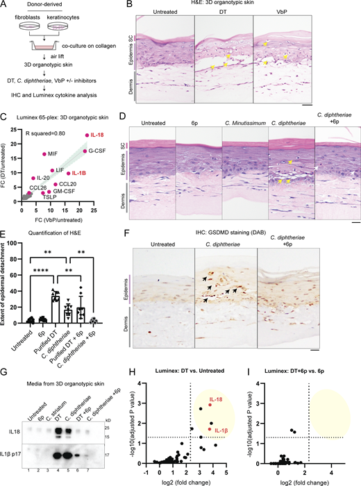 ZAKα inhibition rescues epidermal integrity by limiting pyroptosis in a model of cutaneous diphtheria. (A) Outline of the 3D human skin model of cutaneous diphtheria. (B) H&E staining demonstrating the histological changes caused by DT and VbP. Yellow arrows indicate dyskeratotic keratinocytes with vacuolated cytoplasm and condensed nuclei. Images representative of three biological replicates. Tissues were fixed 24 h after treatment. (C) Correlation between the fold change (FC) of 65 cytokines/chemokines after 24 h of DT or VbP treatment. (D) H&E staining of 3D skin treated with the indicated bacteria filtrate or compound. Yellow arrows indicate dyskeratotic keratinocytes with vacuolated cytoplasm and condensed nuclei. Gray arrows mark putative apoptotic cells with eosin-rich cytosol and condensed nuclei. Compound 6p is a ZAKα inhibitor. Images representative of three biological replicates. Tissues were fixed 24 h after treatment. (E) Quantification of the extent of the detachment between the dermal–epidermal layer based on the H&E staining of 3D skin in D. Significance values were calculated from one-way ANOVA. **, P ≤ 0.01. ****, P ≤ 0.0001. (F) GSDMD p30 staining of 3D skin treated with C. diphtheriae filtrate with and without compound 6p. Black arrows indicate membranous staining around foci of epithelial barrier damage. (G) Western blot of IL-18 and IL-1β p17 in the cultured media of 3D skin after the indicated treatment. (H) Significantly upregulated cytokines/chemokines in DT-treated 3D skin culture relative to untreated 3D skin from D. Log10(adjusted P values) and log2(fold change) were calculated from a multiparametric t test. Fold change cutoff is set at 5. (I) Significantly upregulated cytokines/chemokines in DT + 6p 3D skin culture relative to 6p only 3D skin from D. Log10(adjusted P values) and log2(fold change) were calculated from a multiparametric t test. Fold change cutoff is set at 5. Source data are available for this figure: SourceData F5.