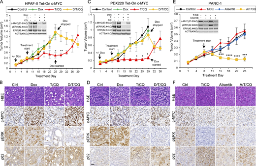 c-MYC determines sensitivity to T/CQ in xenografted pancreatic tumors. (A and C) Tumor volumes of a xenografted human PDAC cell line (HPAF-II; A) and a PDX (PDX220; C) expressing Dox-regulated c-MYC (Tet-On c-MYC) are shown. Insets depict representative immunoblot analysis of cells before injection into NOD/SCID mice. Cells were treated with DMSO (first column), 2 μg/ml Dox, 100 nM trametinib (T), and 20 μM CQ, or the combinations thereof, for 48 h. Tumor-bearing mice were treated with: (1) corn oil (control, n = 3, black line); (2) 625 mg/kg Dox chow (n = 4, green line); (3) 1 mg/kg trametinib and 50 mg/kg CQ (T/CQ, n = 6, red line); or (4) doxycycline, trametinib, and CQ (D/T/CQ, n = 5, yellow line), where n equals the number of mice. Arrows denote start of treatments, including when Dox was started or stopped. Lines are the mean tumor volumes ± SEM. *, P < 0.05; **, P < 0.01; t, P < 0.0005; Student’s two-sided t test. (B and D) Representative images of IHC analysis on xenografted HPAF-II or PDX220 Tet-On c-MYC tumors from mice treated as in A and C. Sections were stained with H&E or with indicated antibodies. Scale bars are 50 μm. (E) Tumor volumes of xenografted PANC-1. Tumor-bearing mice were treated with: (1) corn oil (control, n = 6); (2) 20 mg/kg alisertib (Alisertib, n = 6); (3) trametinib and CQ (T/CQ, n = 6, T: 1 mg/kg and CQ: 50 mg/kg); or (4) the triple combination (A/T/CQ, n = 5, yellow line), where n equals the number of mice. Lines represent the mean ± SEM. ***, P < 0.005; ****, P < 0.001; Student’s two-sided t test. (F) Representative images of IHC on xenografted PANC-1 tumors from mice treated as in E. Sections were stained with H&E or with indicated antibodies. Scale bar represents 50 μm. Source data are available for this figure: SourceData F2. Refer to the image caption for details.