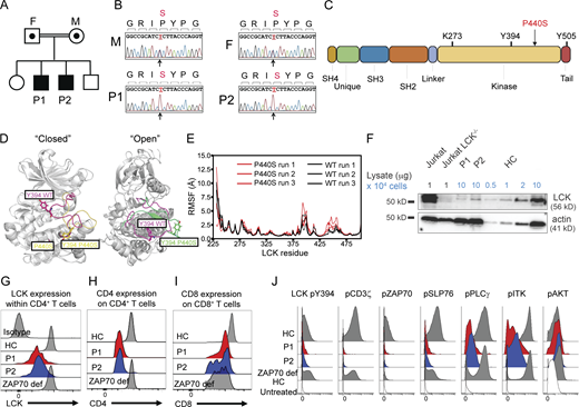 Identification of novel human LCK P440S variant. (A) Pedigree of patients’ families carrying the novel homozygous P440S LCK missense mutation. (B) Sequencing results of the LCK mutation site within parents and patient siblings. (C) Illustration of LCK protein structure. (D) Superimposition of the closed and open forms of WT LCK and P440S LCK. Left panel: Superimposition of the two closed forms; the A-loop regions of WT LCK and P440S LCK in magenta and yellow, respectively. Right panel: Superimposition of the two open forms; the A-loop regions of WT LCK and P440S LCK in magenta and green, respectively. (E) Root mean square fluctuations of the selected residues of WT LCK (black lines) and P440S LCK (red lines) as provided by molecular dynamics simulations. (F) Immunoblot of Jurkat cell lines and sorted CD3+ cells from patient PBMCs. (G) Intracellular flow staining of LCK total protein within patient CD4+ T cells. (H and I) Flow cytometry staining of CD4 and CD8 surface expression on patient T cells. (J) Mass cytometry measurement of intracellular phosphorylated signaling proteins within CD4+ T cells from patient PBMCs treated with pervanadate compared with untreated HC. Source data are available for this figure: SourceData F1.