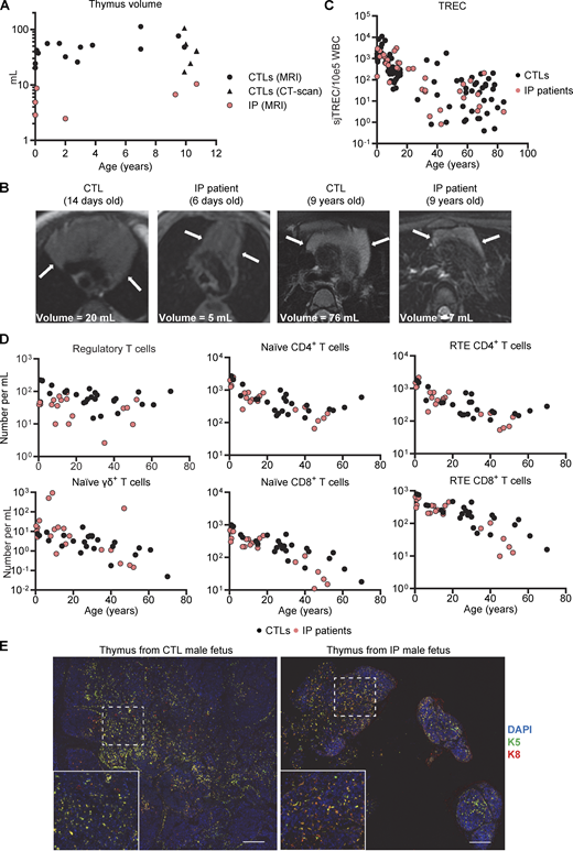 Thymi of IP female patients and a male fetus. (A) Thymus volume, assessed by MRI or computed tomography scan; n = 20 aged-matched controls and n = 6 IP patients. More details regarding controls and patients are provided in Table S6. (B) MRI images of thymi from IP patients and aged-matched controls of the indicated ages. (C) Quantification of TRECs in DNA extracted from the whole blood of healthy donors or patients with IP. Data were merged from three independent experiments. (D) Absolute counts of CD25hiCD127low regulatory CD4+ T cells; naïve (CD45RA+CCR7+) γδ+, CD4+, or CD8+ T cells; and recent thymic emigrants (CD31+CD45RA+CCR7+) CD4+ or CD8+ T cells determined by mass cytometry on fresh whole blood from n = 24 female healthy donors and n = 23 IP patients. Experiments were performed independently and data were merged. (E) DAPI, keratin 5 (K5), and keratin 8 staining of formalin-fixed paraffin-embedded (FFPE) tissues from the thymus of a single male fetus with IP at 19 wk of gestation and of an aged-matched control. Scale bar = 200 μm. Refer to the image caption for details.