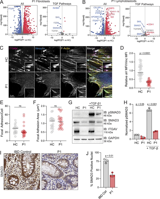 ITGAV variants cause defects in TGF-β signaling and gene expression. (A) Volcano plot of differentially expressed genes between P1 and HC derived fibroblasts (n = 3, adjusted P value <1e−10, DESeq2 Wald) (left). A subset of genes related to TGF-β signaling obtained from Harmonizome 3.0 (right). (B) Volcano plot of overall differentially expressed genes between P1 and a HC derived lymphoblastoid cell line (n = 3 replicates per sample, adjusted P value <1e−10, DESeq2 Wald test) (left). P1 lymphoblasts show loss of ITGAV transcript and upregulation of some immune regulatory genes. A subset of genes related to TGF-β signaling (right). (C–F) Fibroblasts from P1 or HC immunostained for Integrin αV (magenta) and vinculin (cyan) together with phalloidin (yellow) for F-Actin. In D–F, each dot represents a field of view (paired t test, P < 0.0001, ns, ns, n = 3). (G and H) Immunoblotting for pSMAD3 (Ser 423/425), SMAD3, and Integrin αV protein levels in fibroblasts derived from HC or P1 as indicated before and after 20 ng/ml mature TGF-β stimulation for 15 min (n = 3). GAPDH was used as a loading control. Values were normalized to HC (paired t test, P < 0.05, error bars, mean ± SEM). (I and J) Immunohistochemistry staining for SMAD3 in biopsies of the ascending colon obtained from an IBD control patient and P1. Slides were also stained with H&E. Sections were quantified using thresholding of signal in the nucleus by HALO. Three independent sections of the same gut were analyzed (paired t test, P < 0.01, n = 3). Source data are available for this figure: SourceData F3. Refer to the image caption for details.