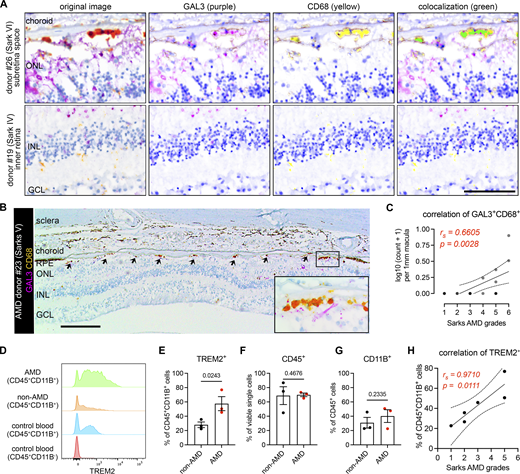 Microglia expressing GAL3 and TREM2 are associated with AMD progression. (A) Multispectral imaging of GAL3 and CD68 co-staining in the subretinal space (top) and inner retina (bottom) from human donors. Unmixed purple spectrum (GAL3) and yellow spectrum (CD68) are shown. The areas of colocalized spectra are highlighted in green. Scale bar: 50 μm. INL, inner nuclear layer. (B) Representative image of GAL3 and CD68 costaining in the macular GA region of a retinal section from an 88-year-old female donor eye with advanced AMD (Sarks V). Arrows indicate double-positive myeloid cells in GA. The black insert box shows the magnification of GA with double-positive cells. Scale bar: 200 μm. GCL, ganglion cell layer. (C) Correlation between the frequencies of macular GAL3+CD68+ double-positive cells (y-axis) and Sarks AMD grading (x-axis) by Spearman’s correlation (n = 18 donors, Table S2). The coefficient and P value are shown. (D) Histograms showing increased TREM2+ myeloid cells (CD45+CD11B+) in RPE/choroid tissues of AMD donors. Concatenated histograms were shown (n = 3 per group). Control human blood samples were used to set up flow gating. (E–G) Quantifications of TREM2+ (E), CD45+ (F), and CD11B+ (G) cell frequencies in RPE/choroid tissues between non-AMD and AMD donors. Unpaired student’s t test is used. P values are shown. (H) Correlation between the frequencies of TREM2+ myeloid cells (y-axis) and Sarks AMD grading (x-axis) in RPE/choroid tissues by Spearman’s correlation. The coefficient and P value are shown.