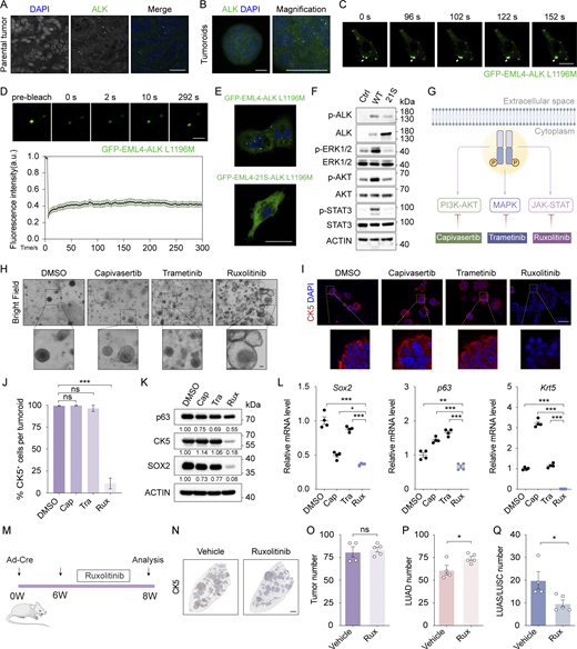 EML4-ALK phase separation regulates AST through activating JAK-STAT signaling. (A) Immunofluorescence staining in club cell–derived EML4-ALK L1196M tumors. ALK in green, nucleus in blue (DAPI staining). Scale bar, 25 μm. (B) Immunofluorescence staining of club cell–derived EML4-ALK L1196M tumoroids. ALK in green, nucleus in blue (DAPI staining). Scale bar, 25 μm. (C) Human bronchial epithelial BEAS-2B cells were transfected with GFP-EML4-ALK L1196M for 12 h and GFP fluorescence was monitored through live imaging. Snapshots at indicated time points showed the fusion event. Scale bar, 10 μm. (D) Top panel shows representative FRAP images of GFP-EML4-ALK L1196M condensates in BEAS-2B cells. The images were taken before and after photobleaching. Scale bar, 2 μm. Bottom panel shows FRAP recovery curve of GFP-EML4-ALK L1196M condensates in BEAS-2B cells. n = 13. (E) BEAS-2B cells were transfected with GFP-EML4-ALK L1196M or GFP-EML4-21S-ALK L1196M and analyzed via confocal microscopy. Scale bar, 25 μm. (F) Western blot analyses of AKT, ERK1/2, and STAT3 phosphorylation. BEAS-2B cells stably expressing EML4-ALK L1196M or EML4-21S-ALK L1196M were deprived of serum and glucose for 2 h and then subjected to western blot analyses. Ctrl, control; WT, GFP-EML4-ALK L1196M; 21S, GFP-EML4-21S-ALK L1196M. (G) Schematic illustration of EML4-ALK downstream signaling pathways and their corresponding inhibitors. (H) Bright field photos of club cell–derived EML4-ALK L1196M tumoroids treated with DMSO, capivasertib (100 nM), trametinib (10 nM), and ruxolitinib (5 μM) for six passages. Scale bar, 50 μm. (I) Representative CK5 immunofluorescence staining in club cell–derived EML4-ALK L1196M tumoroids. CK5 in red, nucleus in blue (DAPI staining). Scale bar, 50 μm. (J) Statistical analysis of CK5+ cell ratio. The numbers of tumoroids analyzed over DMSO, capivasertib, trametinib, and ruxolitinib groups were 20, 18, 21, and 22, respectively. (K) Western blot analyses of p63, CK5, and SOX2. Club cell–derived EML4-ALK L1196M tumoroids were treated with DMSO, 100 nM capivasertib (Cap), 10 nM trametinib (Tra), and 5 μM ruxolitinib (Rux) for six passages and then subjected to western blot analyses. (L) Relative mRNA levels of LUSC signature genes. (M) Experimental design for in vivo treatment of ruxolitinib. W, week. (N) Representative CK5 immunostaining. Scale bar, 1 mm. (O–Q) Statistical analyses of tumor number (O), LUAD number (P), and LUAS/LUSC number (Q) in mice receiving ruxolitinib (n = 5) or vehicle (n = 4). Data in A–F represent one experiment of three independent experiments. Data in H–L and O–Q represent one experiment of two independent experiments. *P < 0.05, **P < 0.01, ***P < 0.001 by one-way ANOVA (J and L), two-tailed unpaired Student’s t test (O–Q). ns: not significant. Data are represented as mean ± SEM. Source data are available for this figure: SourceData F5. Refer to the image caption for details.