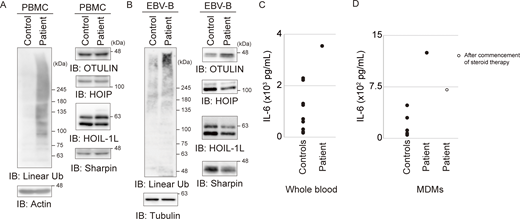 Patient-derived cells show enhanced linear ubiquitination without any reduction in the amount of OULIN. (A and B) The amounts of linear ubiquitin (linear Ub), OTULIN, and LUBAC components in patient-derived PBMCs (A) and patient-derived EBV-B cells (B) compared with those in healthy control cells. (C) IL-6 levels in the supernatant of IL-1β–stimulated whole blood samples from the patient and seven healthy controls. (D) IL-6 levels in culture supernatant from IL-1β–stimulated CD14-positive macrophages isolated from the patient before and after steroid treatment (compared with levels in seven healthy controls). IB, immunoblot. Source data are available for this figure: SourceData F2.