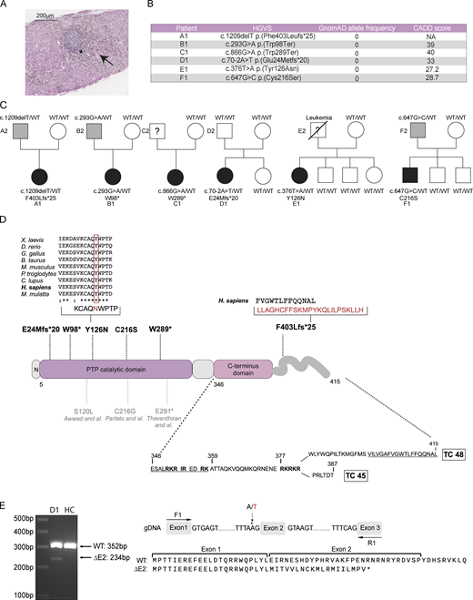 Pedigrees and genetics of families carrying PTPN2 mutations. (A) Anatomopathological section of liver biopsy showing lesions of chronic hepatitis and cholangitis (Metavir A3F3) with an inflammatory infiltrate compatible with a lupus-type autoimmune etiology. Hematoxylin-eosin saffron staining: portal tract inflammatory infiltrate with lymphoid follicles (*) and piecemeal necrosis (arrows). HGVS, Human Genome Variation Society. (B) cDNA mutations, GnomAD allele frequency (v2.1), and CADD score. (C) Family pedigrees with probands indicated by A1, B1, C1, D1, E1, F1. Squares: males; circles: females; black: affected mutation carriers; grey: unaffected mutation carriers. WT: WT PTPN2 allele. Under each patient is the genotype at the specified locus. (D) Linear protein model showing the location of the described PTPN2 variants (represented in bold) together with previously published variants (in grey). Multiple alignments of PTPN2 orthologs from different species using the Clustal Omega software. The affected amino acid for Y126N is boxed in red. Residues corresponding to bipartite NLS are underlined. TC, T cell. (E) cDNA from EBV-transformed B cells of patient D1 and one HC were amplified around exon 2. Migration and sequencing of PCR products are represented along with the expected result of RNA translation with exon 2 skipping. Source data are available for this figure: SourceData F1. Refer to the image caption for details.