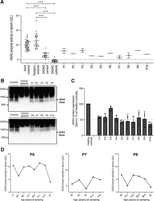 Serum ADA2 enzymatic activity of suspected DADA2 patients. (A) ADA2 enzyme activity (U/L) measured in serum samples of suspected DADA2 patients (n = 10), adult healthy controls (n = 35), pediatric healthy controls (n = 17), healthy DADA2 carriers (n = 19), and DADA2 patients (n = 18). Each data point is plotted with the mean ± SD. Statistical significance was assessed using the Mann–Whitney U test, ***P < 0.0001. (B) ADA2 protein secretion in serum samples of pediatric controls, adult controls, DADA2 patients, and cohort patients by western blot. (C) Quantification of ADA2 secretion in serum samples of pediatric controls, adult controls, DADA2 patients, and cohort patients. Bar graphs represent the percentage of ADA2 protein secretion relative to pediatric/adult controls. Each bar represents the mean ± SD from three independent experiments. (D) Longitudinal follow-up of ADA2 enzymatic activity in serum samples of P5, P7, and P8. Source data are available for this figure: SourceData F7. Refer to the image caption for details.