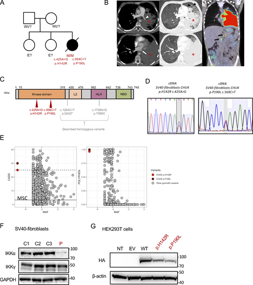 Pedigree, clinical manifestations, and mutations of a patient with immunodeficiency. (A) Pedigree of the family; “wt” indicates a wt genotype for CHUK, E? indicates that we don’t have the genotype of this family member. (B) Aspect of primary pulmonary lymphoma on the CT scan: consolidation of the lower two-thirds of the left lung (asterisk) with the invasion of the mediastinum, infiltration of the left pulmonary artery (white arrowhead), and complete thrombosis of the left pulmonary veins (white arrow). Thickening of the interlobular septa in the remainder of the ventilated lung, consistent with venous stasis or carcinomatous lymphangitis (black arrowhead). No normal lymph nodes or adenomegaly were individualized in the mediastinum or in the pulmonary hilum. A few small lymph nodes were visible in the axillary areas. The PET-CDFDG 18F performed within 48 h showed hypermetabolism of the lesions and in three coeliomesenteric lymphadenopathies (black arrows). (C) Localization of the mutation on the protein sequence of IKKα. The patient mutations are shown in red, while previously in vitro validated reported variants are in gray. (D) Sanger sequencing of RT-PCR products (cDNA) from the indicated cells. (E) Combined annotation-dependent depletion score versus minor allele frequency (CADD-MAF) (left panel) and polyphen score versus MAF (right panel). The patient variants are in red and dark red, and the other gnomAD variants are in gray. MSC: mean significance cutoff for CHUK CADD score (3.13). (F) Protein expression of IKKα and IKKγ οn protein lysates from healthy controls SV40-fibroblasts and the patient (P, in red). GAPDH was used as a protein loading control. (G) Protein expression of HA-tagged IKKα on protein lysates from transfected HEK293T cells with the different variants, the wt, or an EV. The patient variants are displayed in red. Source data are available for this figure: SourceData F1. Refer to the image caption for details.