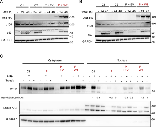 Reconstitution of patient cells with IKKα restored the non-canonical NF-κB defect in vitro. (A and B) Patient cells were transduced with an EV (P+EV) lentivirus or containing the coding sequence of wt IKKα (P+wt). GFP-positive cells were sorted, and cell lysate after activation of the non-canonical pathway by LTαβ (A) or Tweak (B) were subjected to western blot. p100 and p52 were revealed using specific antibodies and GAPDH was used as a loading control. Representative of three independent experiments. (C) Patient cells were transduced with an EV (P+EV) lentivirus or containing the coding sequence of wt IKKα (P+wt). GFP-positive cells were sorted. After activation with either LTαβ or Tweak, cytoplasmic and nuclear protein separation was performed and subjected to western blot. RELB was assessed using a specific C-terminal antibody to assess its nuclear translocation after activation in transduced patient’s cells compared with controls. α-Tubulin was used as a loading control of cytoplasmic extract while Lamin A/C was used for nuclear extracts. RELB protein expression was quantified and normalized to the quantity of Lamin A/C in arbitrary units. Representative of three independent experiments. Source data are available for this figure: SourceData F6. Refer to the image caption for details.
