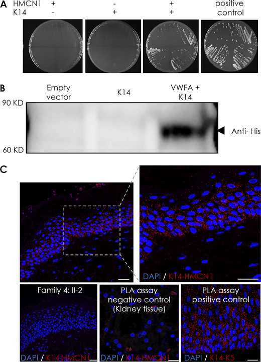 Hemicentin-1 directly interacts with K14. (A) A solid growth assay was used to validate hemicentin-1–K14 interaction identified in the Y2H assay. Yeasts were transfected with pB29-HMCN1 (aa 1–212, hemicentin-1) bait vector and pP7-KRT14 (aa 92–188, K14) prey vector. Yeast colonies were grown on DO-3 media (without tryptophan, leucine, and histidine), which selects for yeast harboring interacting bait and prey proteins. Note the presence of colonies in yeasts transfected with both constructs only. (B) Flag-tagged K14 and His-tagged hemicentin-1 VWFA domain-expressing plasmids were transfected into HeLa cells. Hemicentin-1 VWFA domain and K14 were co-immunoprecipitated using anti-Flag antibody-conjugated magnetic beads followed by immunoblotting of the precipitated proteins using anti-His antibody. The experiment was repeated three times with similar results. (C) PLA was performed using antibodies directed against hemicentin-1 and K14 in healthy human skin sections. Red dots indicate positive interaction (the experiment was repeated two times). The experiment was repeated using a skin biopsy taken from individual II-2, family 4 (scale bar, 50 μm), or kidney tissue a negative control. In addition, a PLA assay using antibodies directed against keratin 5 (K5) and K14 served as a positive control (scale bars, 25 μm). Source data are available for this figure: SourceData F4.