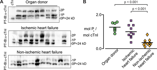 Heart failure type-specific decrease in cTnI phosphorylation. (A) Phosphorylation levels in left ventricular samples were determined by Phos-tag SDS-PAGE, followed by a Western blot against cTnI (top). Unphosphorylated cTnI (indicated by 0P, where human cTnI weighs 24,008 D) migrates faster than single (1P) or doubly (2P) phosphorylated cTnI. Unphosphorylated recombinant troponin (cTn, left lane) was used as a negative control, and each lane represents a single cardiac sample from a donor or patient. (B) Densitometry analysis for each lane in A was used to calculate the level of cTnI phosphorylation. A single measurement was made for each of the 7 donor hearts and 10 hearts from each heart failure group, indicated in Tables 1 and 2. Source data are available for this figure: SourceData F5. Refer to the image caption for details.