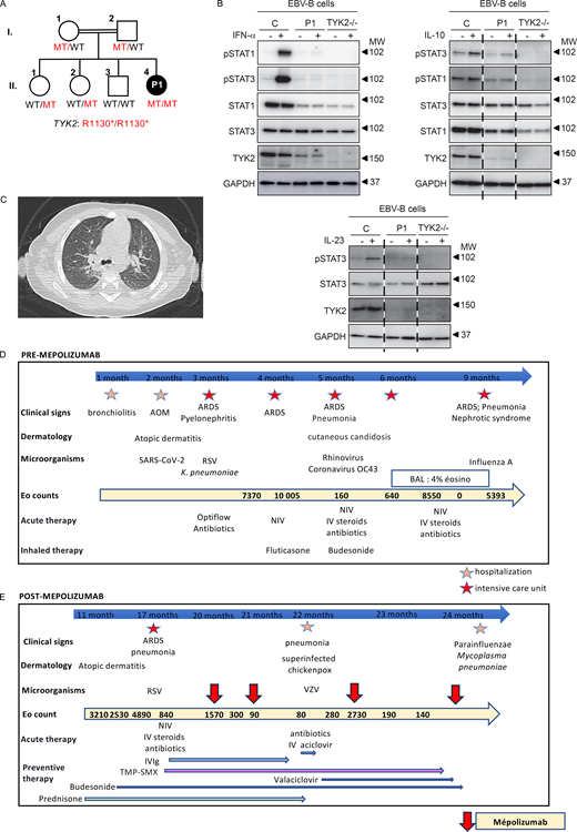 Clinical and cellular characteristics of the TYK2 deficient patient. (A) Family pedigree showing the segregation of the TYK2 mutant (MT) allele. Double lines connect the two consanguineous parents. The closed black symbol indicates the proband (patient 1, P1) with TYK2 deficiency, and the open symbols indicate healthy family members. WT: wildtype. (B) Western blotting of the EBV-B cells from P1, showing TYK2 deficiency. The TYK2, STAT1, STAT3, pSTAT1, pSTAT3, and GAPDH proteins are shown. The response to IFN-α, IL-23 and IL-10 was similar to that in patients with complete TYK2 deficiency. MW, molecular weight in kD. (C) Computed tomography of P1 showing bilateral lung opacities. (D) Initial outcome before mepolizumab treatment. RSV: respiratory syncytial virus; BAL: bronchoalveolar lavage; NIV: noninvasive ventilation; IV: intravenous. AOM: acute otitis media. ARDS: acute respiratory distress syndrome. VZV: varicella zoster virus. (E) Outcome after mepolizumab treatment. IV IgG: intravenous immunoglobulin; TMP-SMX: trimethoprim-sulfamethoxazole. Source data are available for this figure: SourceData F1. Refer to the image caption for details.