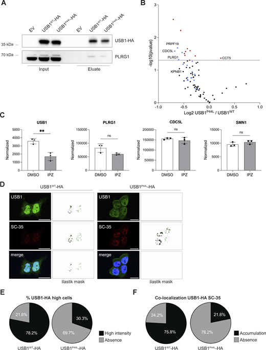 USB1 de novo variant impacts USB1 protein interactome. (A) HEK293T-USB1-HA lysates were immunoprecipitated using magnetic bead-bound anti-HA antibodies and analyzed by immunoblotting to validate the co-immunoprecipitation mass spectrometry results (n = 4). EV, empty vector. (B) Volcano plot of co-immunoprecipitation mass spectrometry experiments performed with HEK293T cells overexpressing USB1-HA variants (n = 4). Red dots denote statistically significantly enriched proteins. Known USB1 interactors are marked in blue. (C) Mass spectrometry analysis of nuclear fraction of DMSO- and IPZ-treated NB-4 cells (n = 3) (17). Proteomics data were obtained at PRIDE (PRoteomics IDEntification Database) under accession number PXD056172. An unpaired t test was performed for USB1 and its interactors (PLRG1, CDC5L, and SMN1). ns, nonsignificant differences (P ≥ 0.05), **P < 0.01. (D) Representative confocal microscopy images for HEK293T cells stably expressing USB1WT or USB1P44L variant (n = 3). SC-35 was included to visualize the nuclear speckles. Scale bar = 15 µm. For each image, pixel classification was performed using a machine learning Ilastik model, and the resulting mask is displayed. For the USB1-HA signal, we trained the model to create a mask of high-intensity signal voxels. (E) Percentage of cells presenting USB1-HA high-intensity signal in the nuclei (n = 3). (F) Signal overlap between USB1-HA and SC-35 was quantified using 3D pixel classification via an Ilastik machine learning model, focusing on high-intensity USB1-HA pixels. A threshold of 27 voxels was applied to define a cellular compartment. Semiautomated quantification was executed in Fiji (RRID:SCR_002285). IPZ, importazole. Source data are available for this figure: SourceData F4. Refer to the image caption for details.