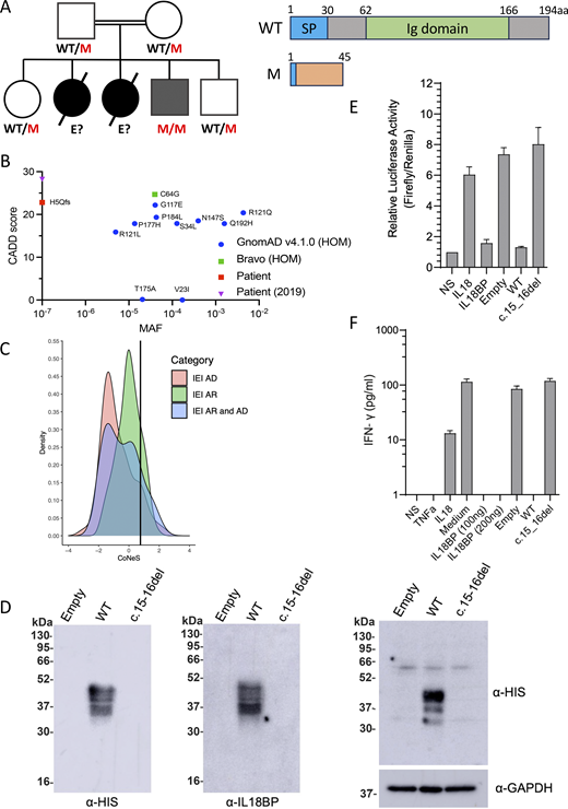 IL18BP c.15-16del is loss-of-function.(A) Pedigree and familial segregation of the mutations and schematic representation of IL-18BP. (B) CADD vs. MAF graph for homozygous IL18BP variants from gnomAD and Bravo and the patients’ allele. (C) CoNeS score of IL-18BP. (D) Representative western blot for secreted IL-18BP (His-tag) in non-concentrated supernatant (10 μg protein/lane) (left) and for intracellular IL-18BP (His-tag) in lysates (20 μg protein/lane) (right) from transiently transfected COS7 cells. Data are representative of five independent experiments. (E) Relative luciferase activity (Firefly to Renilla signal ratio) in HEK293 cells transiently transfected with NF-κB–Firefly luciferase + IL-18RAP + Renilla luciferase plasmids upon 12-h stimulation with recombinant IL-18 (5 ng/ml) and/or recombinant WT IL-18BP-His (100 ng/ml) or concentrated supernatant (100 μg/ml of total protein) from COS7 cells transiently transfected with empty, WT, or mutant IL-18BP–tagged constructs. Relative luciferase activity was normalized against non-stimulated (NS) cells, for which the value was set to 1. (F) IFN-γ production detected by ELISA on the supernatant of KG-1 cells stimulated for 24 h with recombinant TNF (20 ng/ml), recombinant IL-18 (20 ng/ml), and/or recombinant WT IL-18BP-His (100–200 ng/ml) or concentrated supernatant (175 μg/ml of total protein) from COS7 cells transiently transfected with empty, WT, or mutant IL-18BP–tagged constructs. (E and F) Data are presented as the mean ± SEM of five independent experiments. All IL-18BP constructs and supernatants were generated as previously described (2). WT, wild-type; M, mutated; E?, unknown genotype; SP, Signal peptide; P, patient; MAF, minor allele frequency; HOM, homozygous; IEI, Inborn errors of Immunity; AD, autosomal dominant. Source data are available for this figure: SourceData F1.