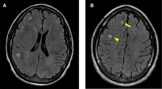 The patient’s magnetic resonance imaging (MRI) of the brain at presentation. A, axial fluid-attenuated inversion recovery (FLAIR) imaging of the brain shows multifocal hyperintensities at the gray–white matter interface. B, axial FLAIR imaging of the brain shows a hyperintense lesion at the right frontal gray–white matter interface (arrow) and a hyperintense lesion in the right frontal white matter (arrowhead).